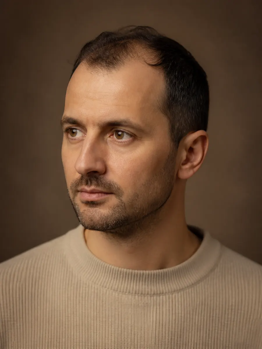 Man with an established receding hairline and thinning crown, treatment in Laval
