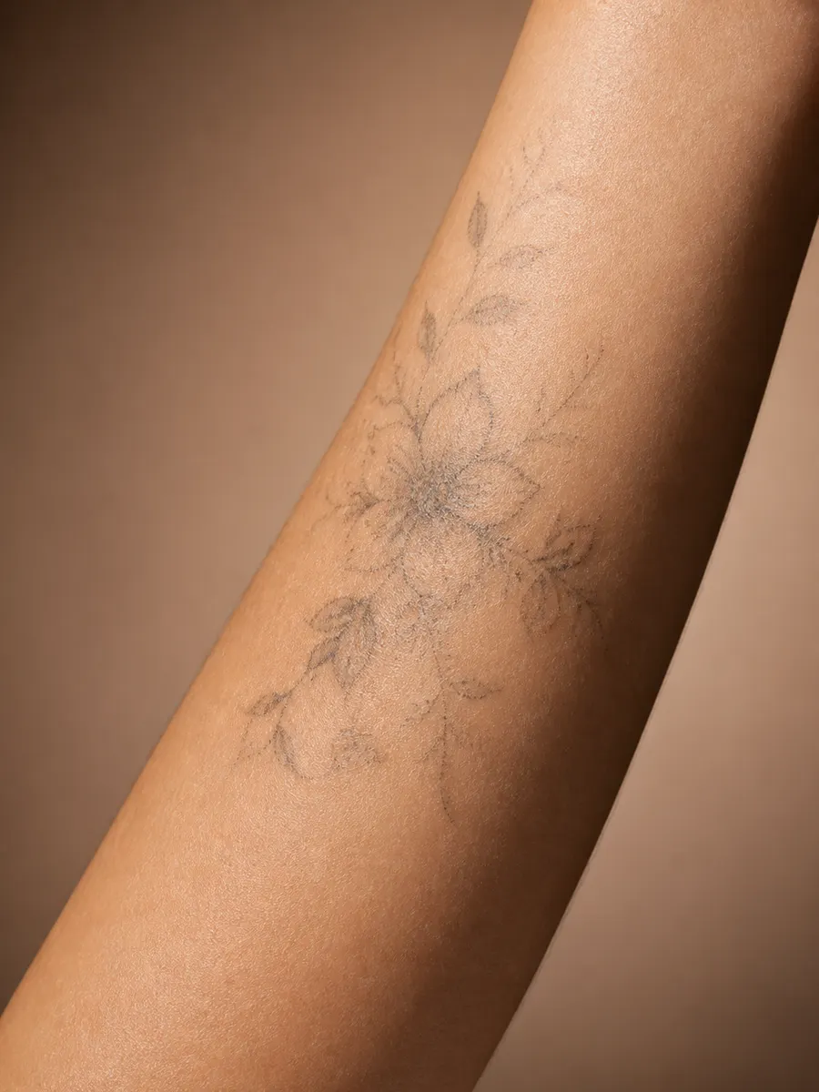 Half-removed tattoo with lightened, broken-up ink over the course of sessions in Laval
