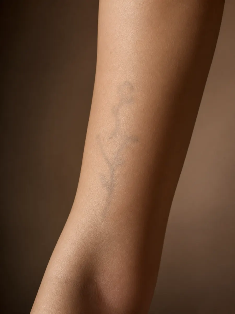 Clear skin where the old tattoo is only a faint grey shadow, the final removal result