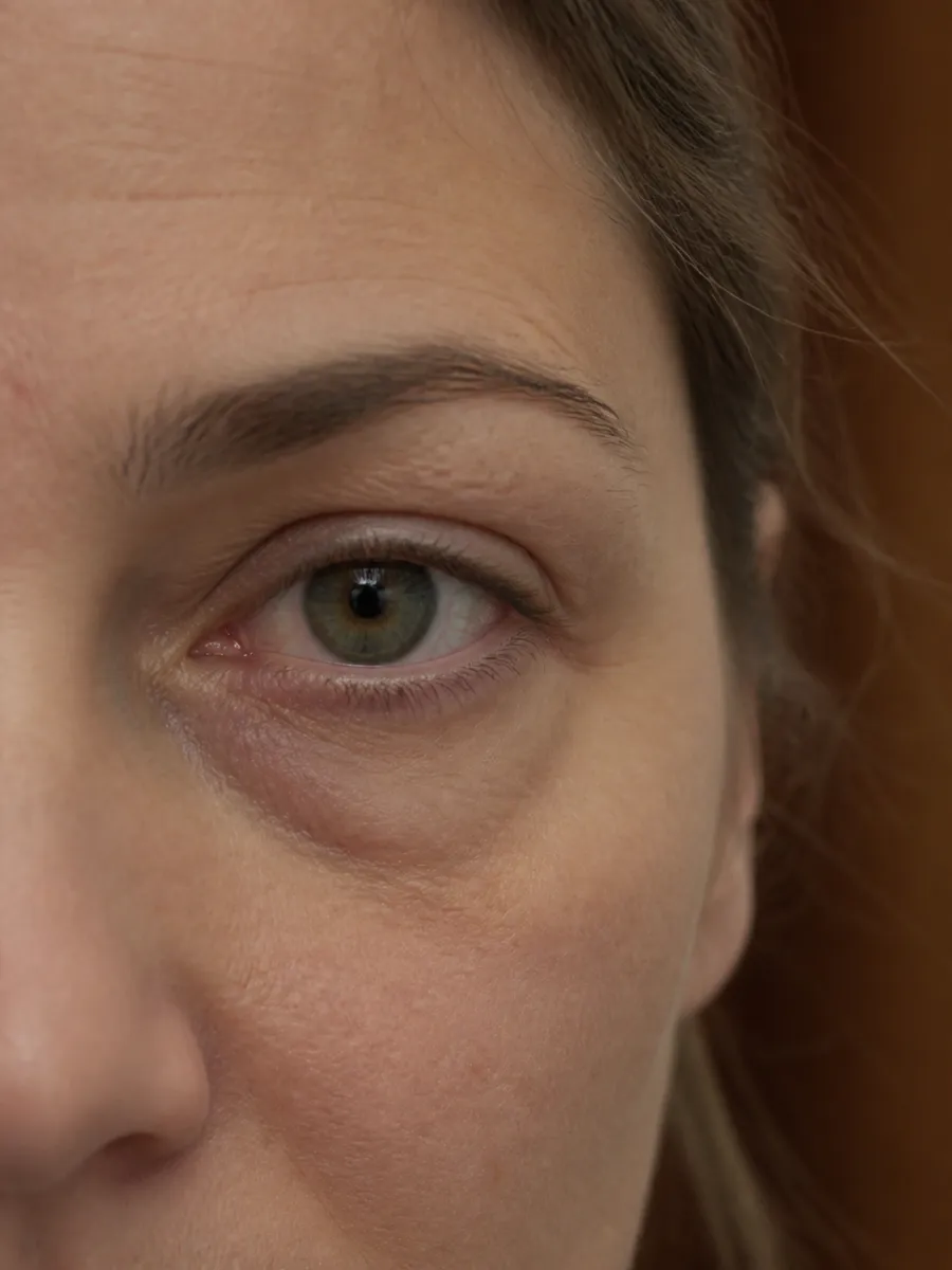 Close-up of an under-eye area: a marked hollow casting a shadowed circle, Clinique DC in Sainte-Rose, Laval