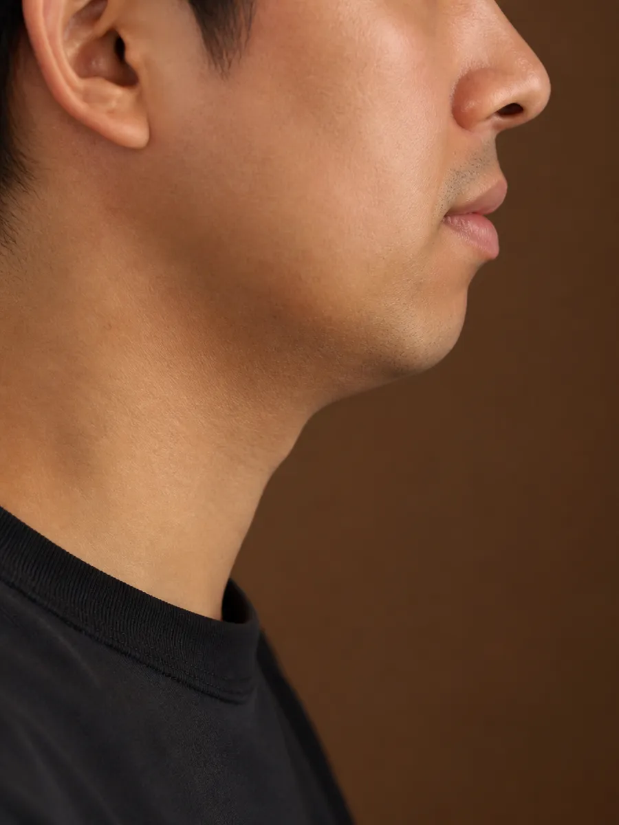 Profile of a man whose jawline lacks definition and blends into the neck, Clinique DC in Sainte-Rose, Laval