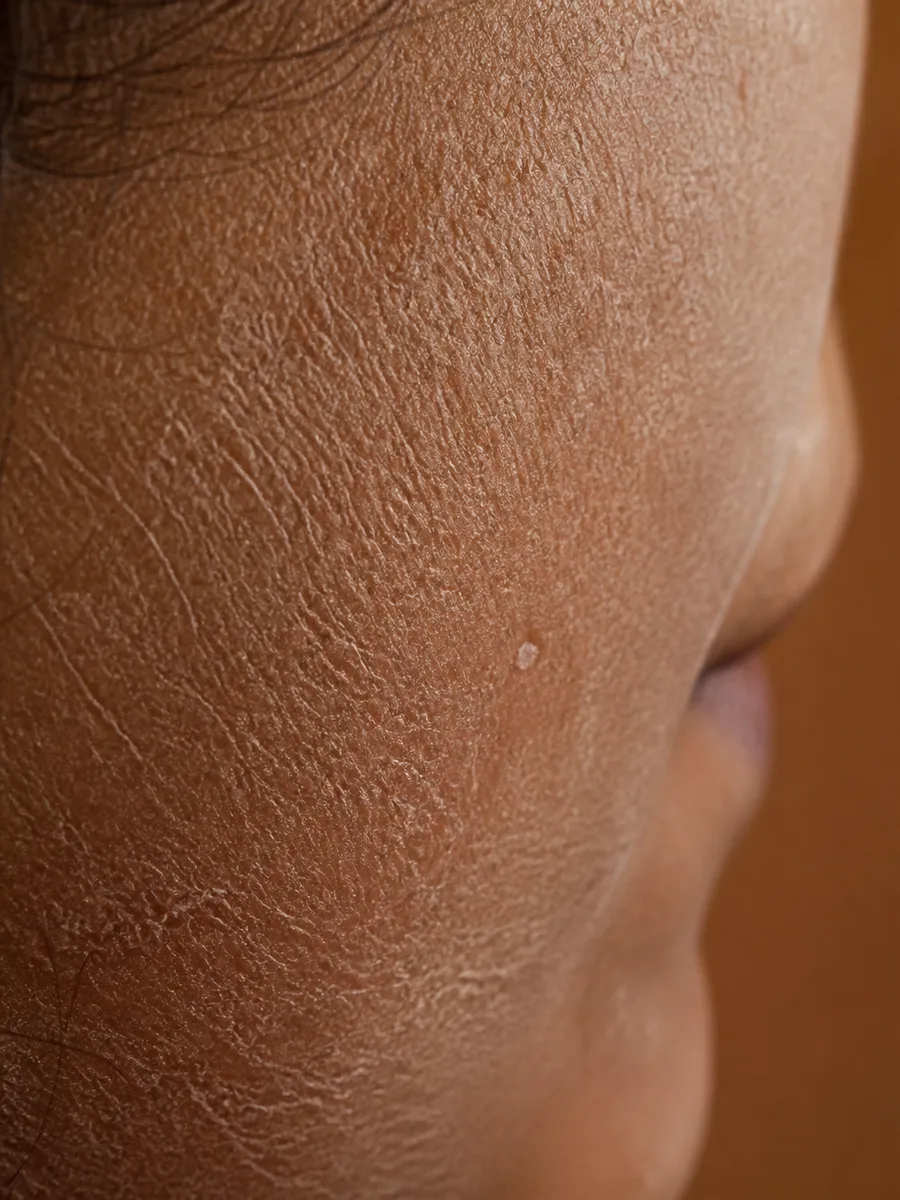 Macro of dehydrated skin: a matte, tight cheek marked by a fine net of dehydration lines, Clinique DC in Sainte-Rose, Laval