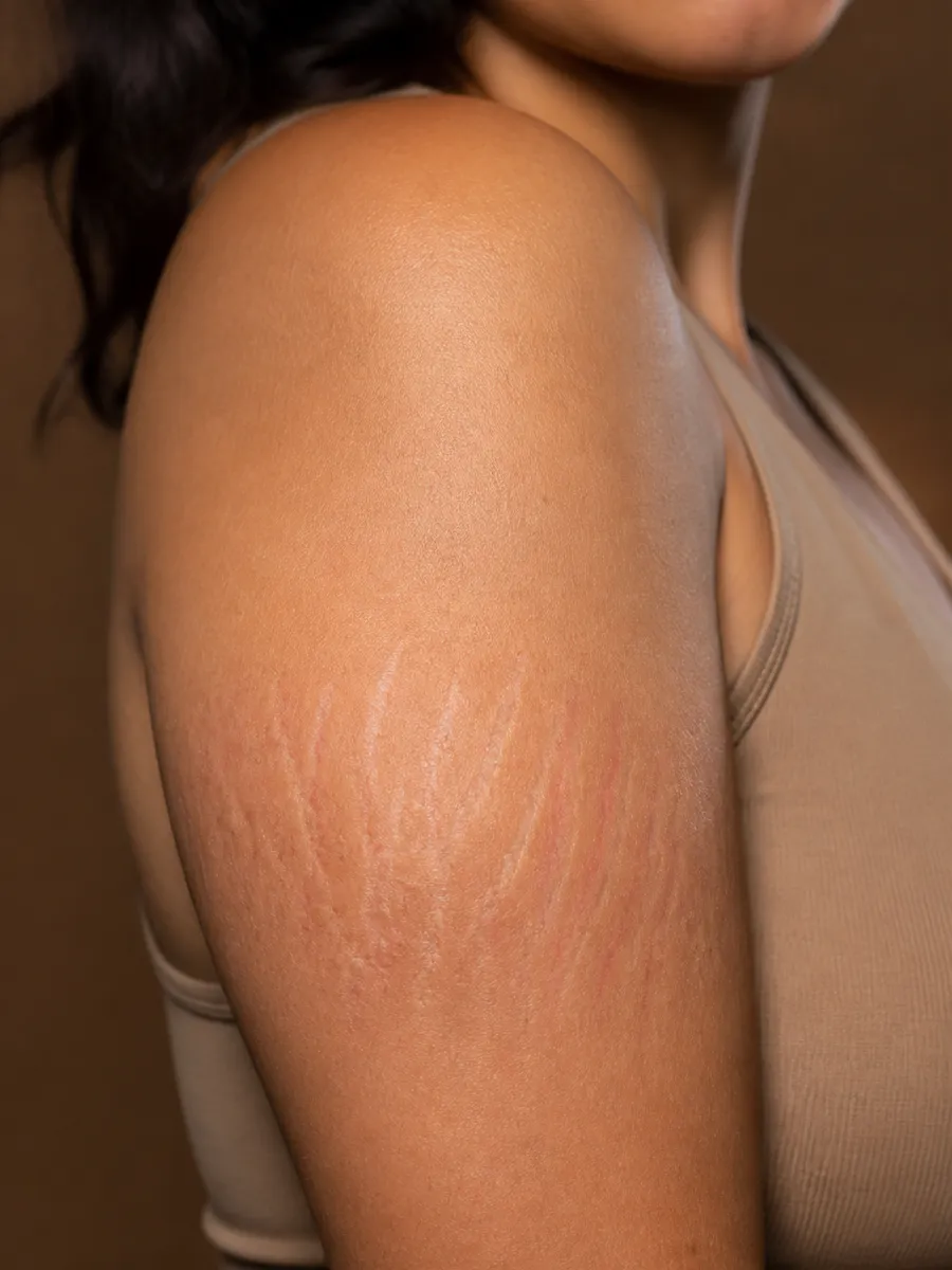 Close-up of an arm showing stretch marks, white and pink striae on the skin, Clinique DC in Sainte-Rose, Laval
