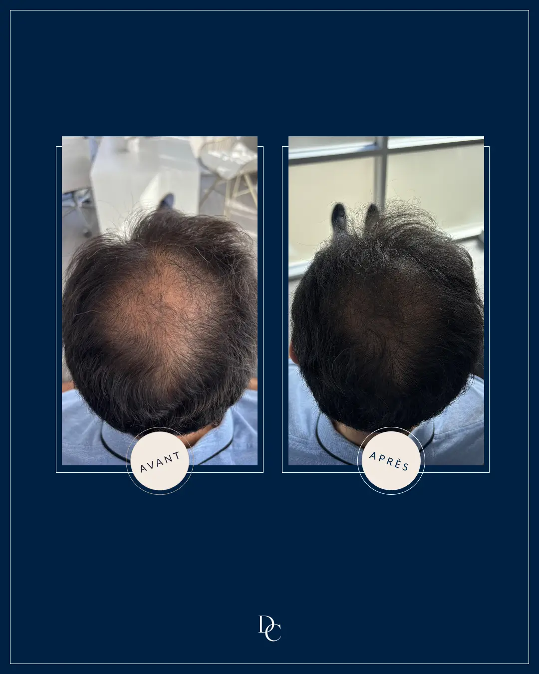 Before and after on the top of the scalp, salt-and-pepper hair.