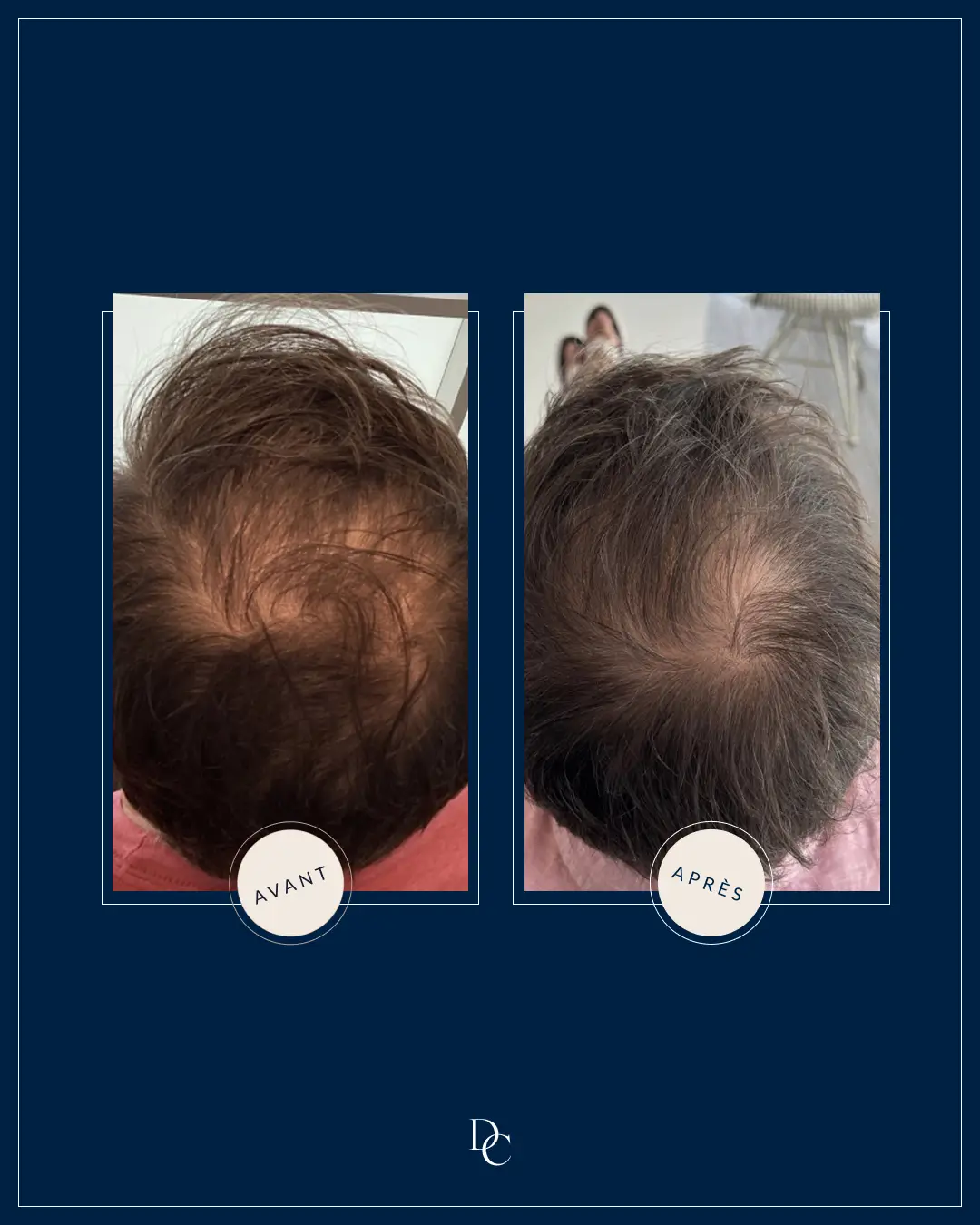 Before and after on the top of the scalp, brown hair.
