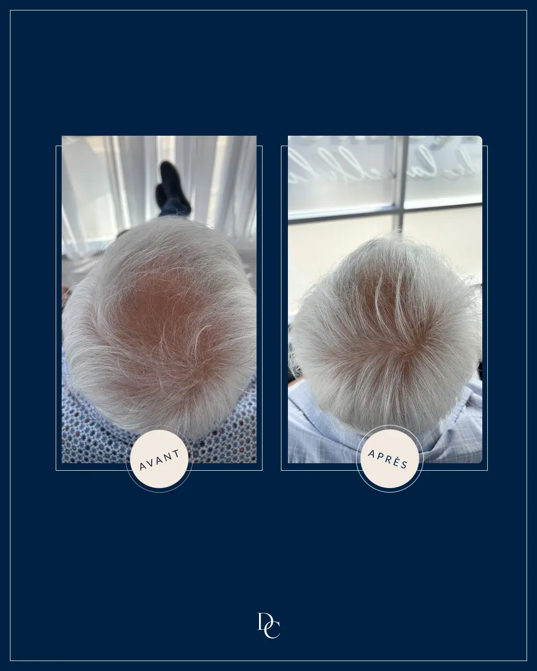 Before and after on the top of the scalp, white hair.