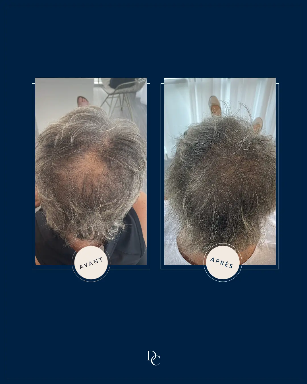 Before and after on the top of the scalp, grey hair.