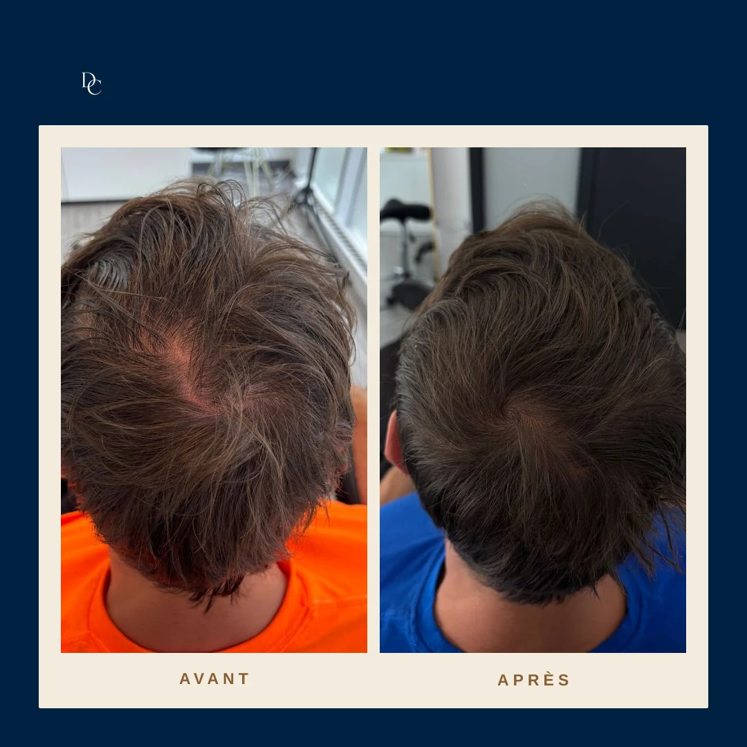 Avant et après sur le sommet du crâne d’un homme, cheveux bruns : la couronne clairsemée se voit moins.