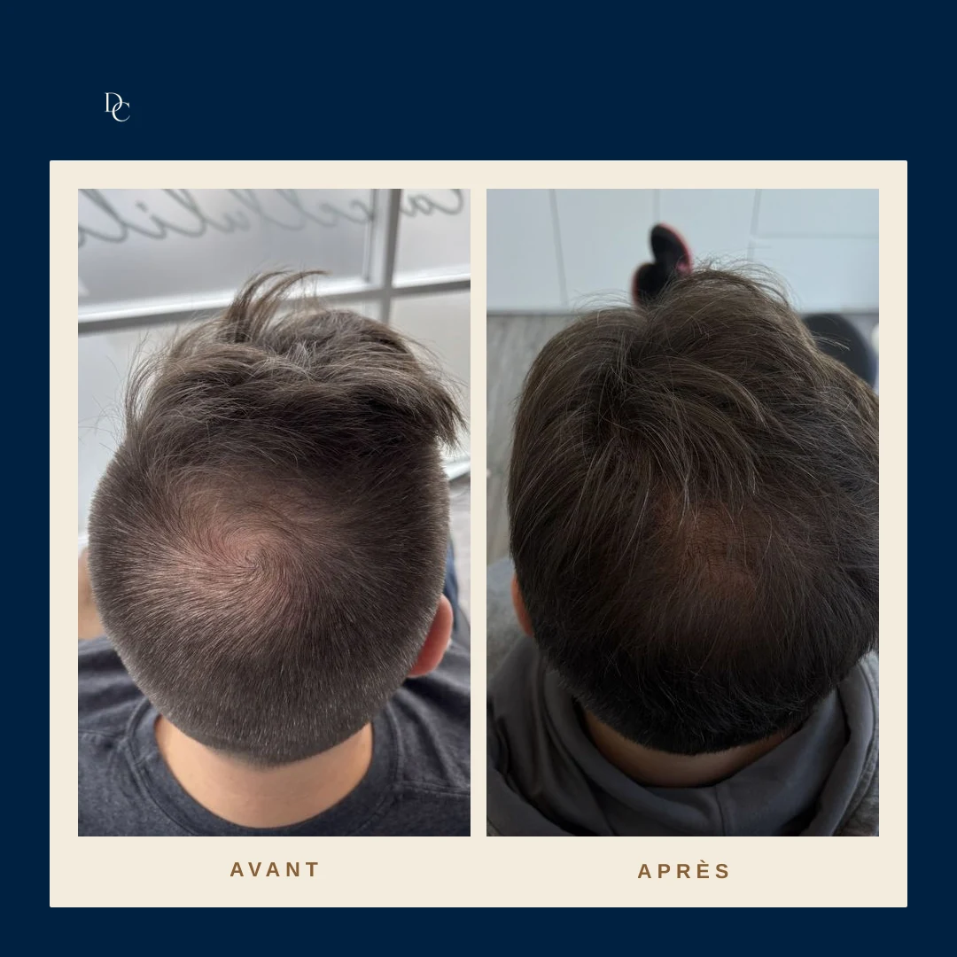 Avant et après sur la couronne d’un homme, cheveux châtains courts : le cuir chevelu visible au centre se recouvre.