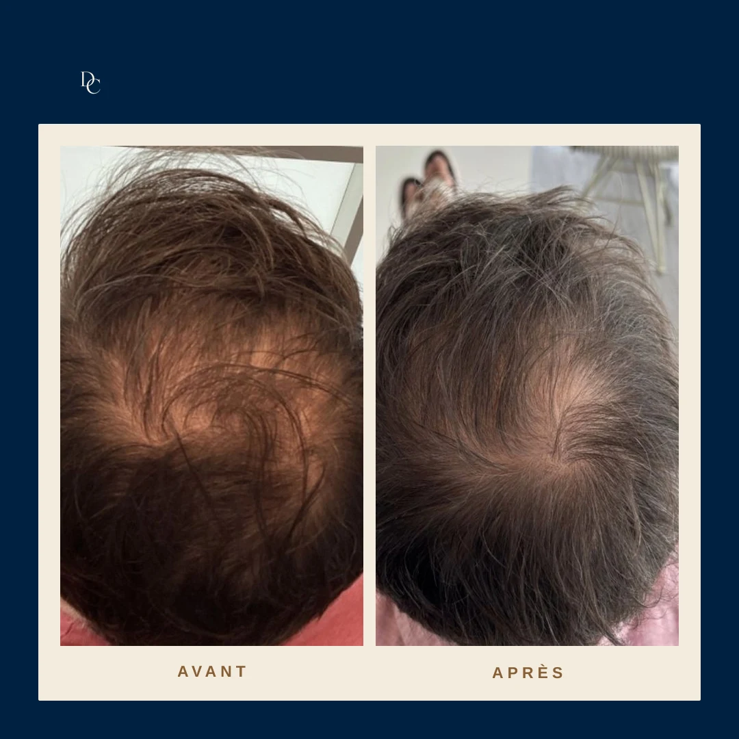 Avant et après sur le sommet du crâne d’un homme, cheveux châtains mi-longs, vu de haut.