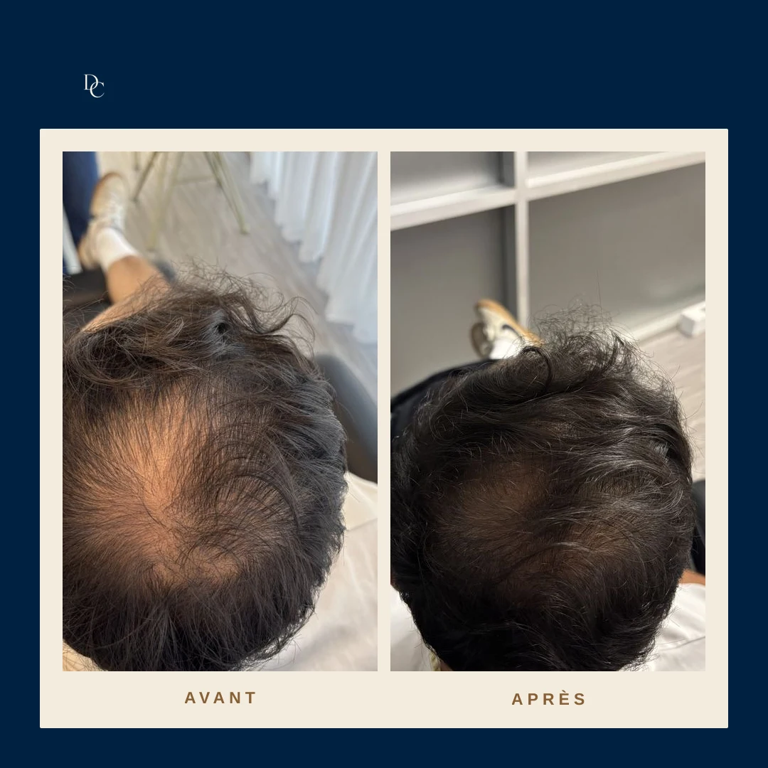 Avant et après sur la couronne d’un homme, cheveux foncés ondulés : la zone dégarnie derrière le sommet se recouvre.