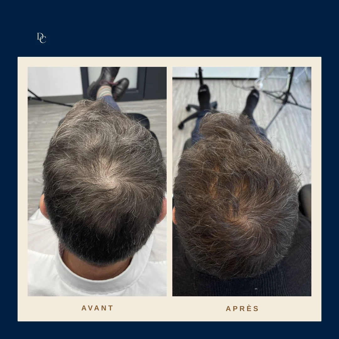 Avant et après sur la couronne d’un homme, cheveux poivre et sel : le cuir chevelu visible au centre se voit moins.