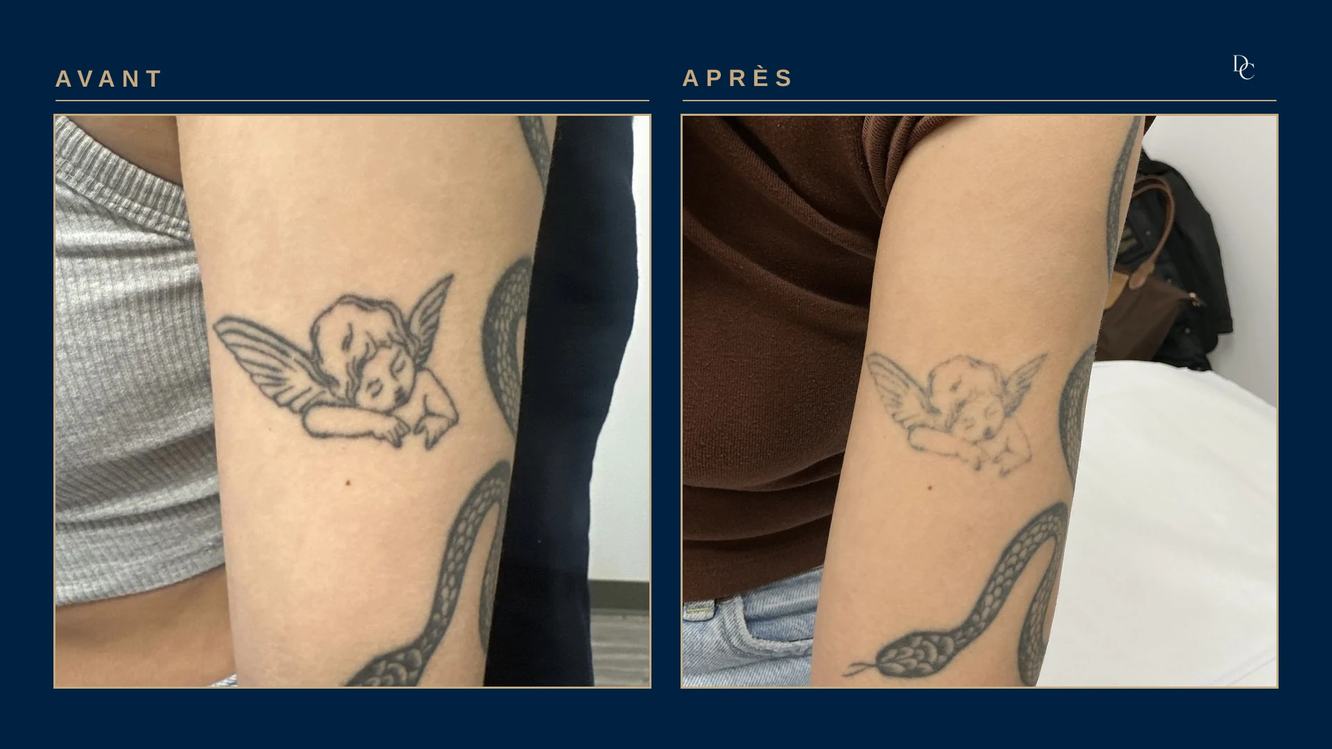 A woman’s upper arm: a black-ink cherub tattoo, then the cherub faded to a pale outline; the untreated snake next to it stays dark.