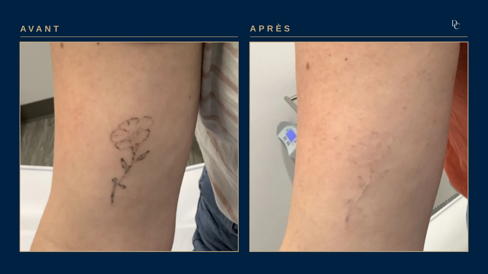 Back of a woman’s arm: a small fine-line flower, then a few barely visible traces in the same spot.