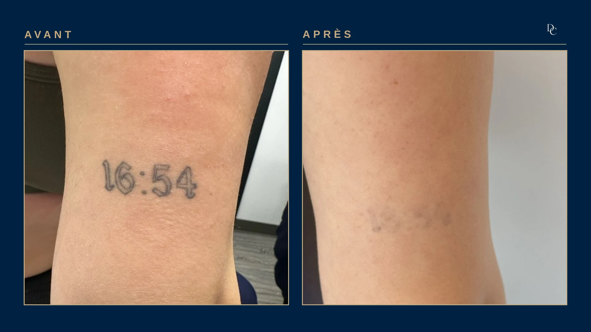 Back of a woman’s arm: the time “16:54” tattooed in black numerals, then a very pale grey trace, photographed from slightly further away.
