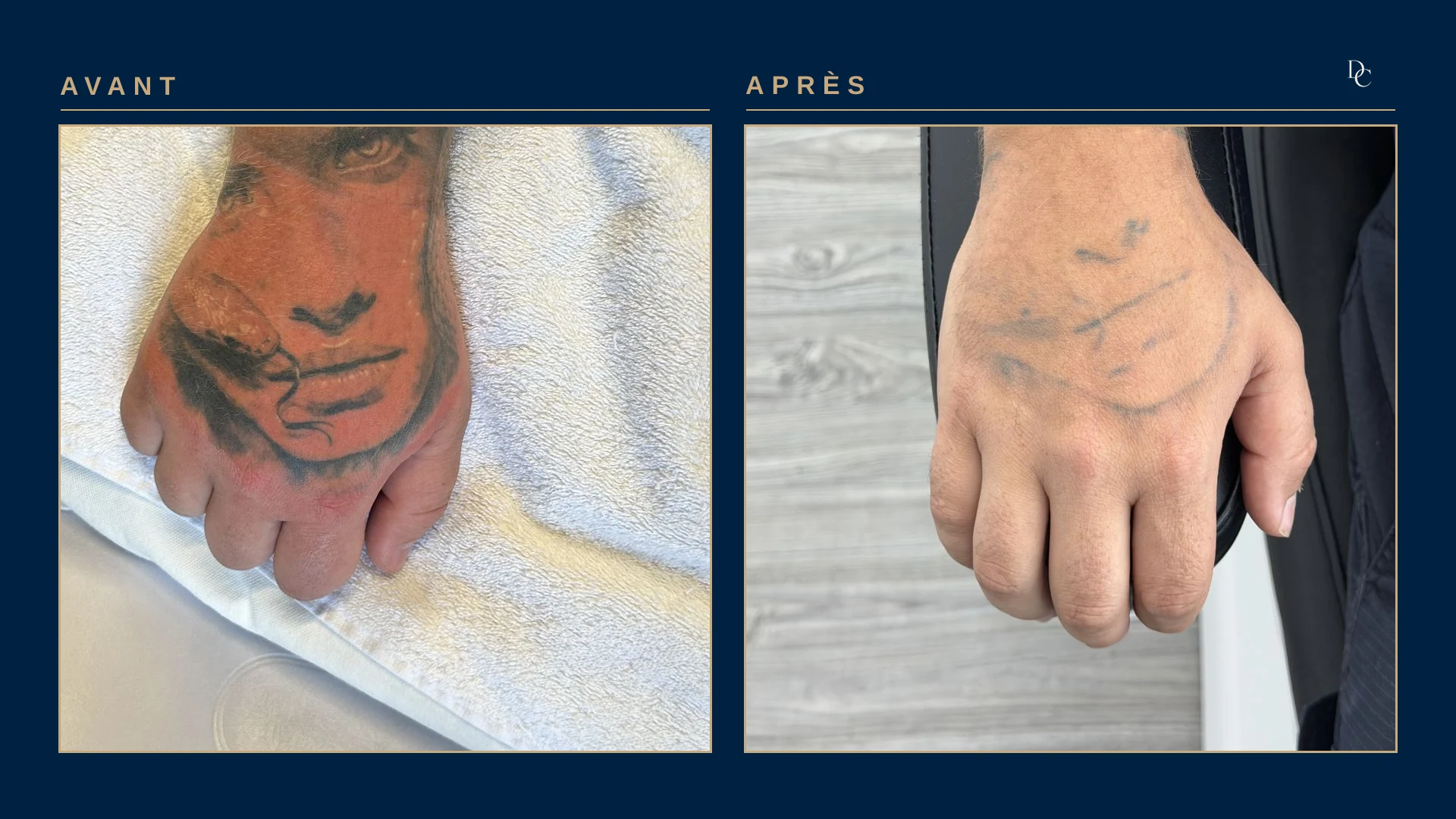 Back of the hand: a black and orange face tattoo covering the hand, then a few residual grey outlines.