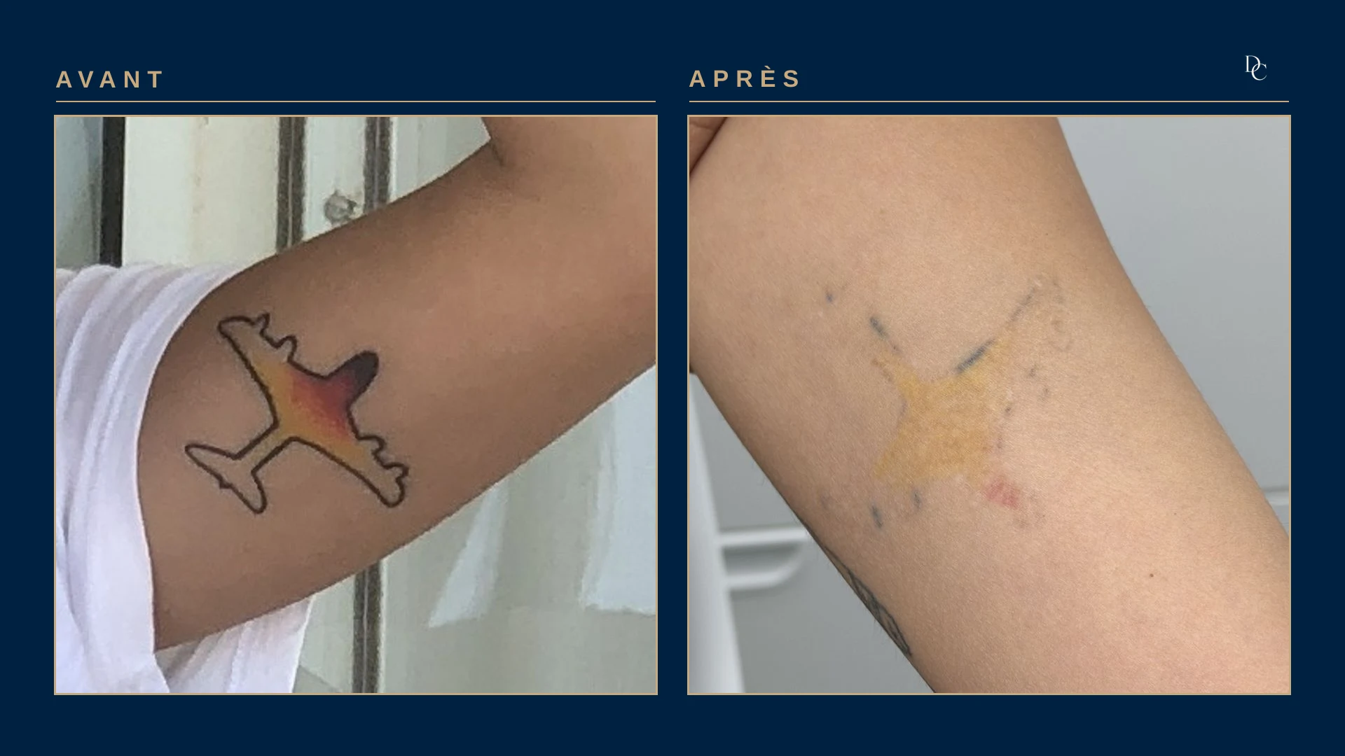 Inner arm: an airplane tattoo with a black outline and yellow, orange and red fill, then a few black dots and a pale yellow patch that remain.
