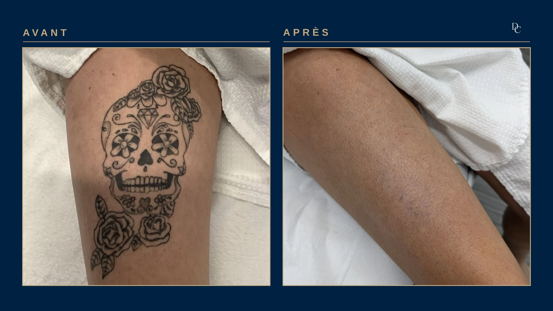 A woman’s thigh: a black-ink sugar skull with roses, then almost even skin with a faint haze of grey dots.