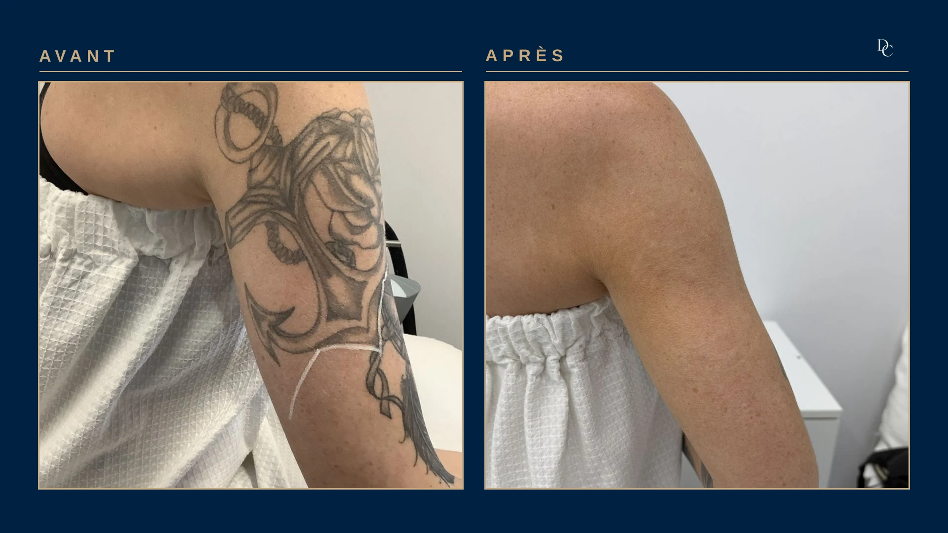 Back of a woman’s arm: a large black-ink anchor with rope, then the same area with no visible trace in the photo.