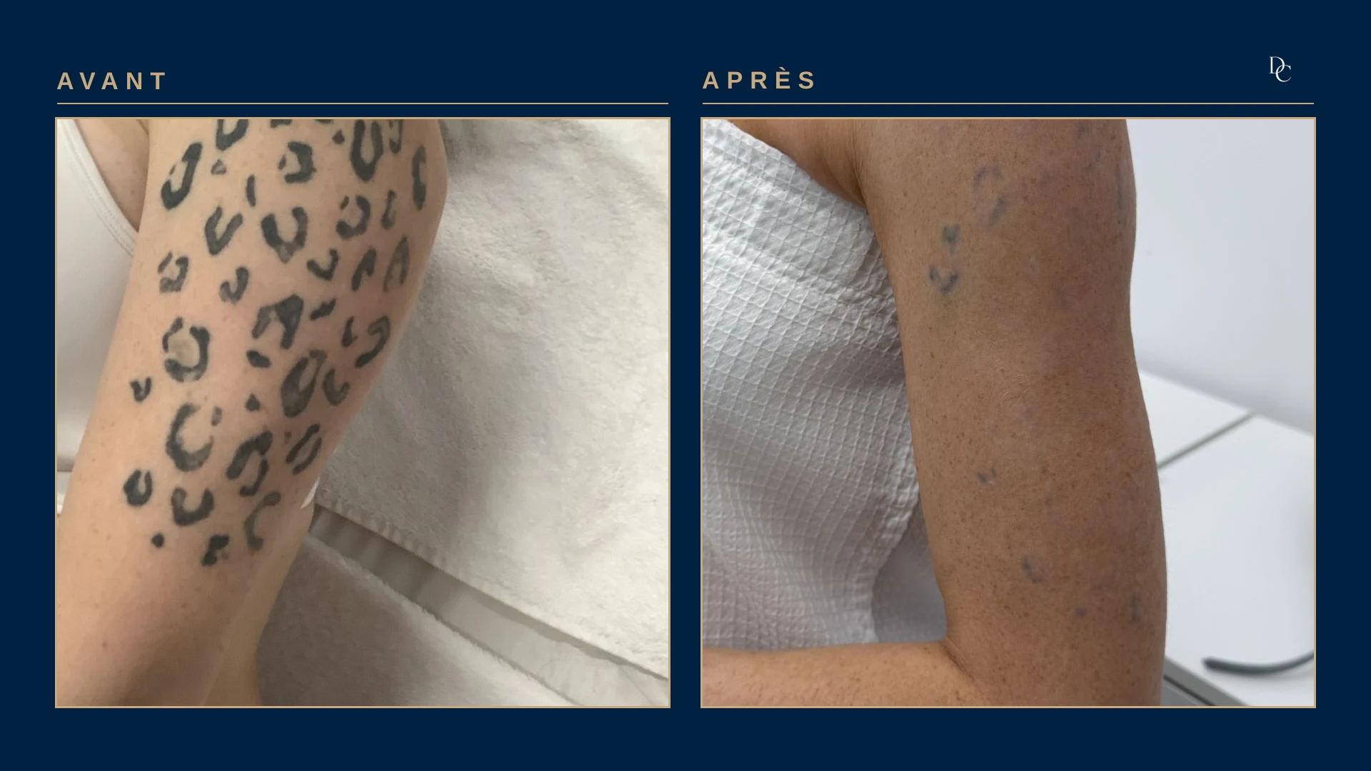 A woman’s arm: a black leopard pattern from shoulder to elbow, then a few bluish spots left on the upper arm.