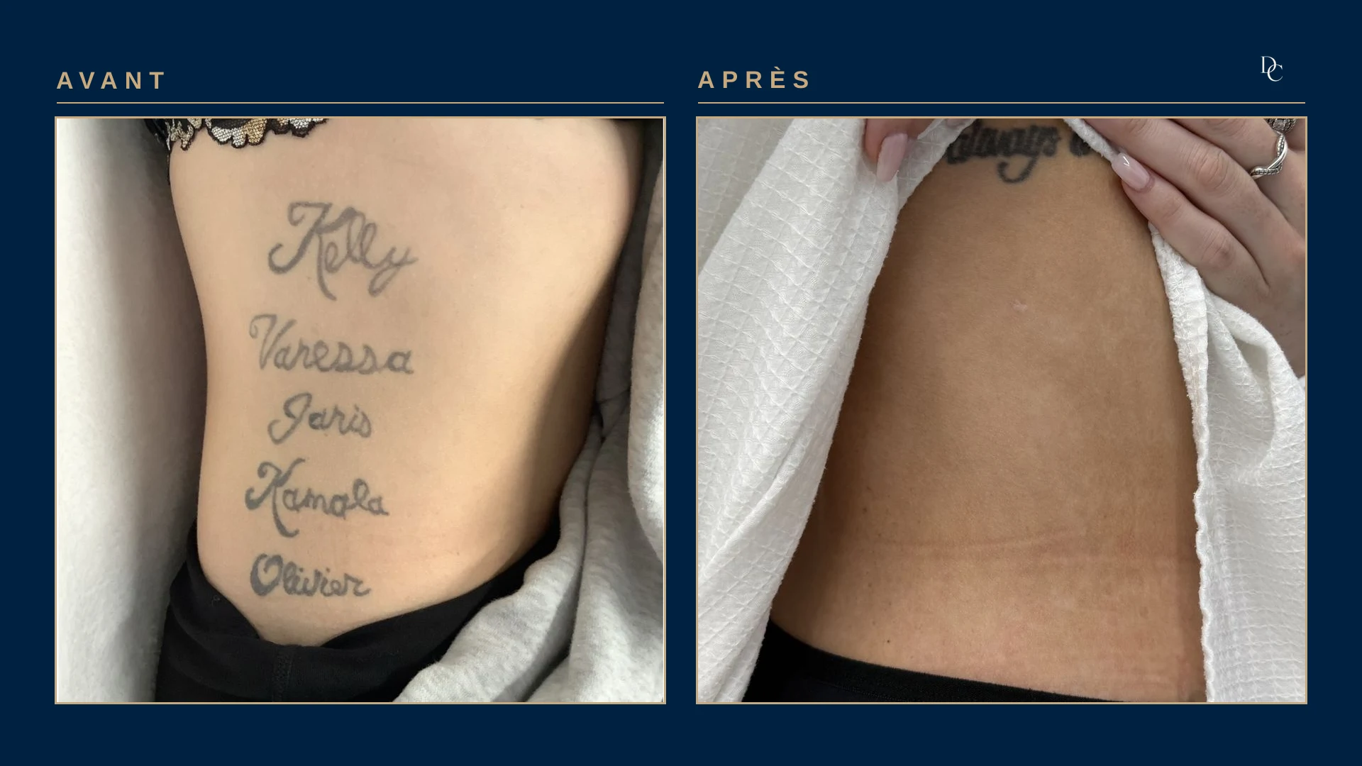 A woman’s ribs: five names in grey cursive, then the same area with no visible trace; another tattoo higher up is untreated.
