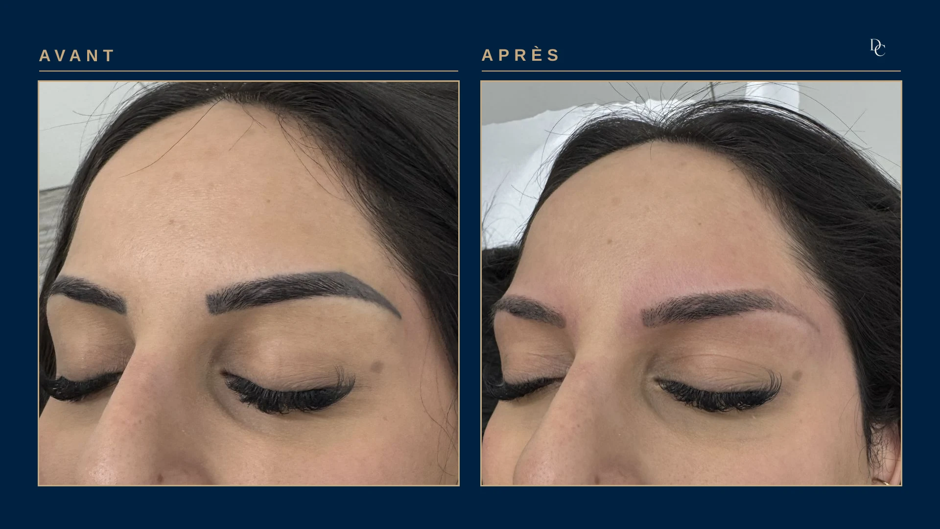 Same patient, right three-quarter view: a dark, arched tattooed brow, then a lighter brow, pink from the session.