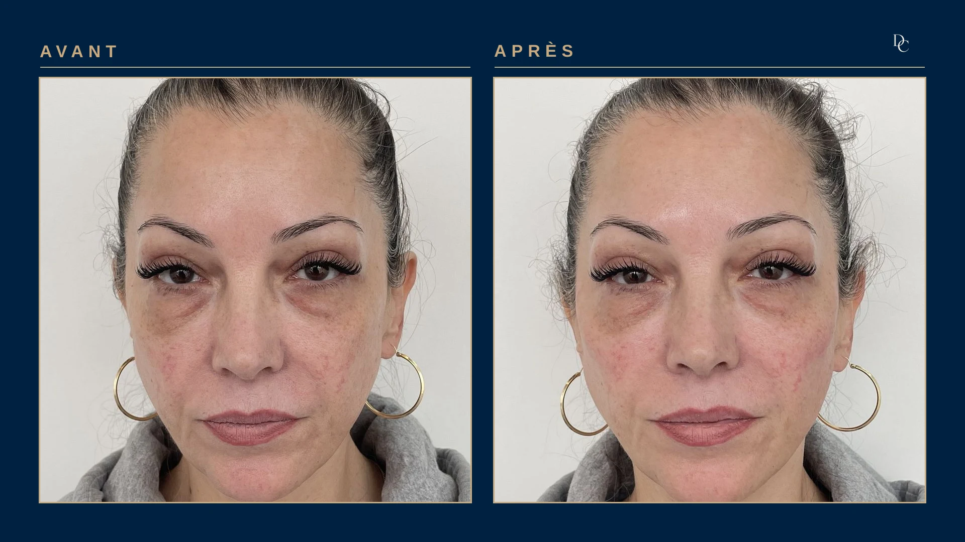 Avant et après 3 ml aux pommettes, de face, sur une femme dans la cinquantaine : le haut des joues est plus rempli et le creux sous les pommettes moins marqué.