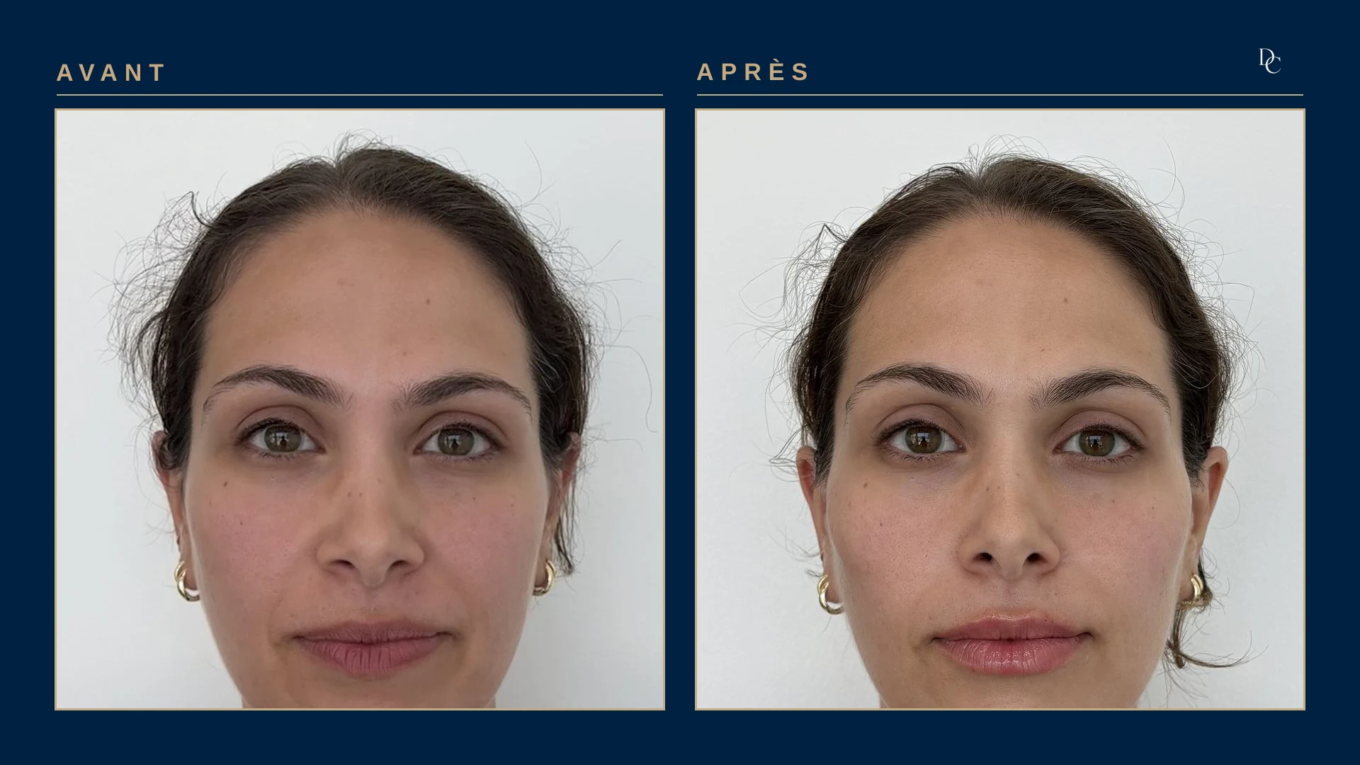 Avant et après 2,5 ml aux joues et 0,5 ml aux lèvres, de face, sur une femme dans la quarantaine : les pommettes sont plus hautes et les lèvres un peu plus pleines.