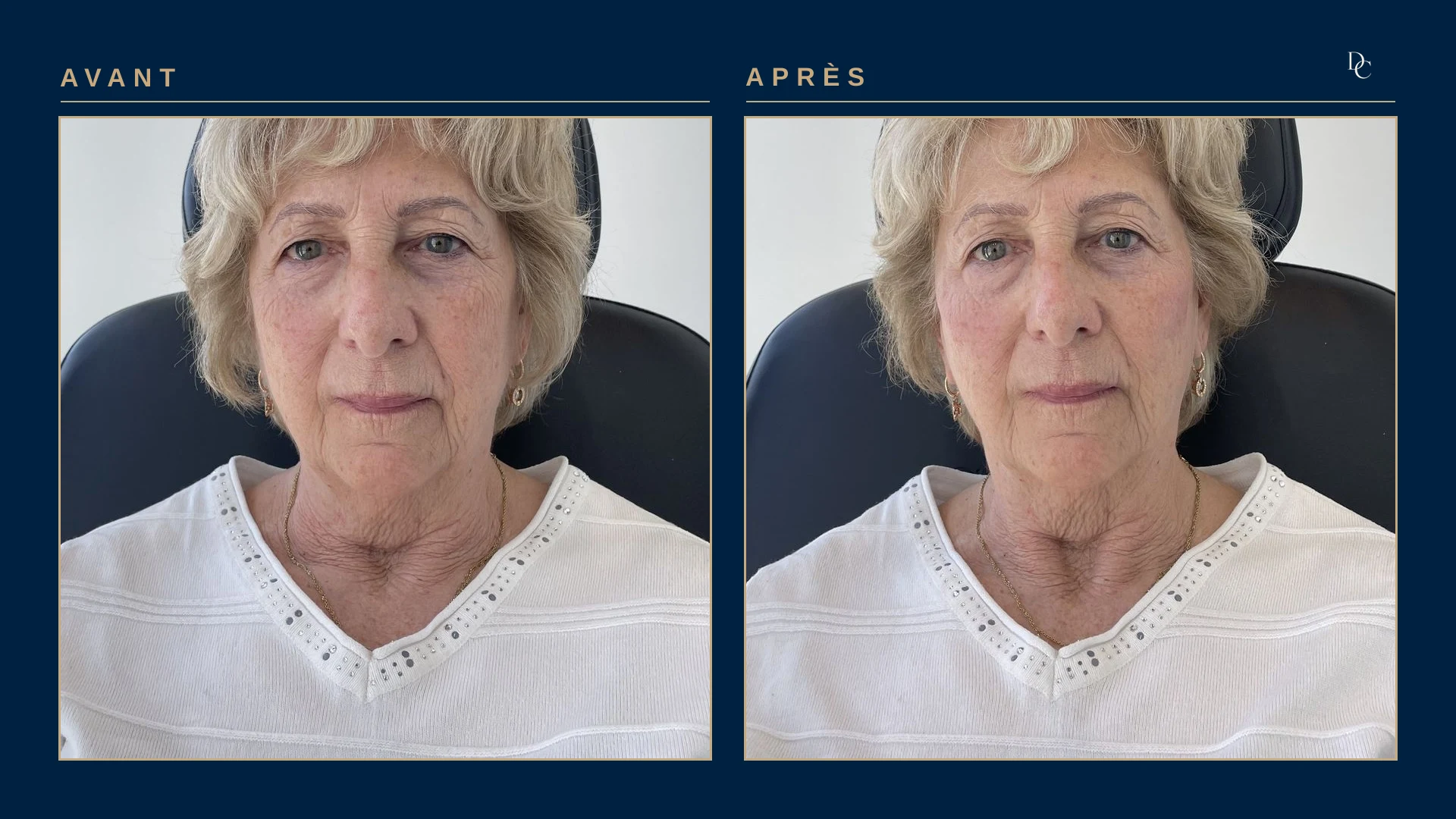 Avant et après 3 ml aux joues, de face, sur une femme d’environ soixante-dix ans : le milieu du visage a retrouvé du volume et les plis de chaque côté de la bouche sont adoucis.
