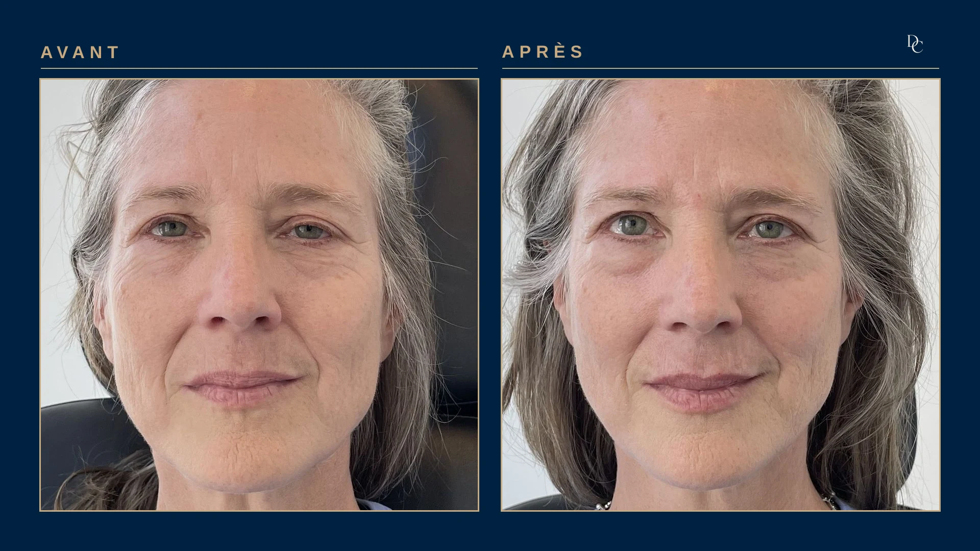 Avant et après 3 ml aux joues, de face, sur une femme dans la soixantaine : le milieu du visage est plus plein et les plis de chaque côté de la bouche sont adoucis.