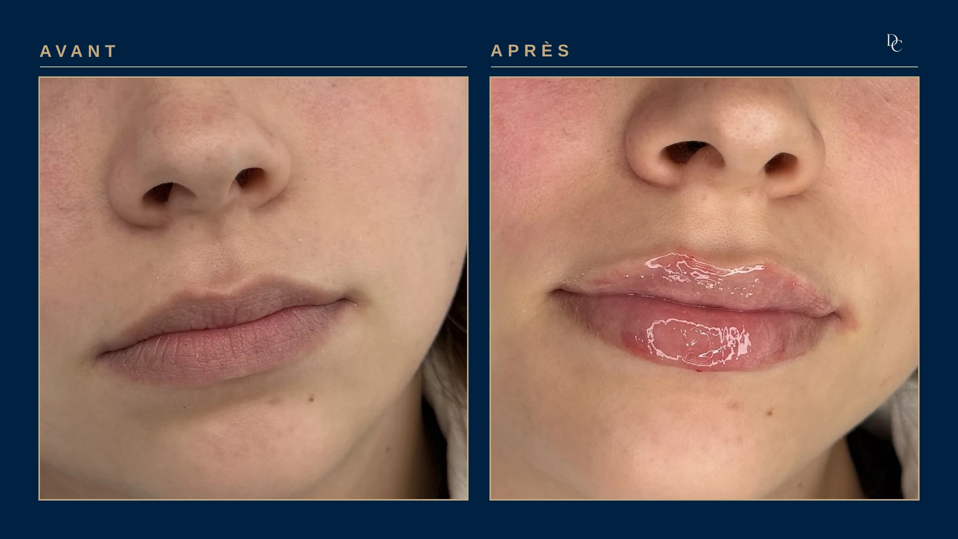 Gros plan sur les lèvres, avant et après 1 ml aux lèvres, de face, sur une femme dans la cinquantaine : les lèvres, qui s’étaient amincies, ont retrouvé du volume.