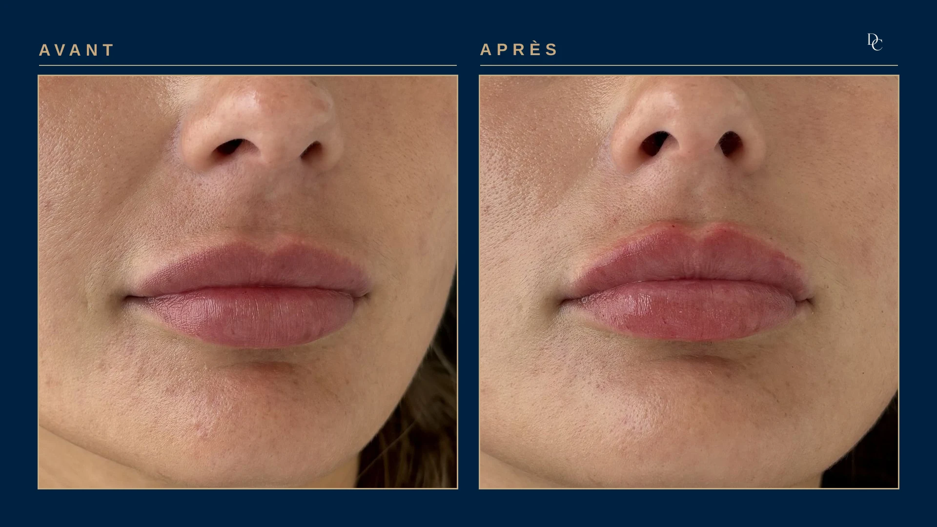 Gros plan sur les lèvres, avant et après 0,5 ml aux lèvres, de trois quarts, allongée, sur une jeune femme dans la vingtaine : les lèvres sont plus pleines, surtout la lèvre supérieure.