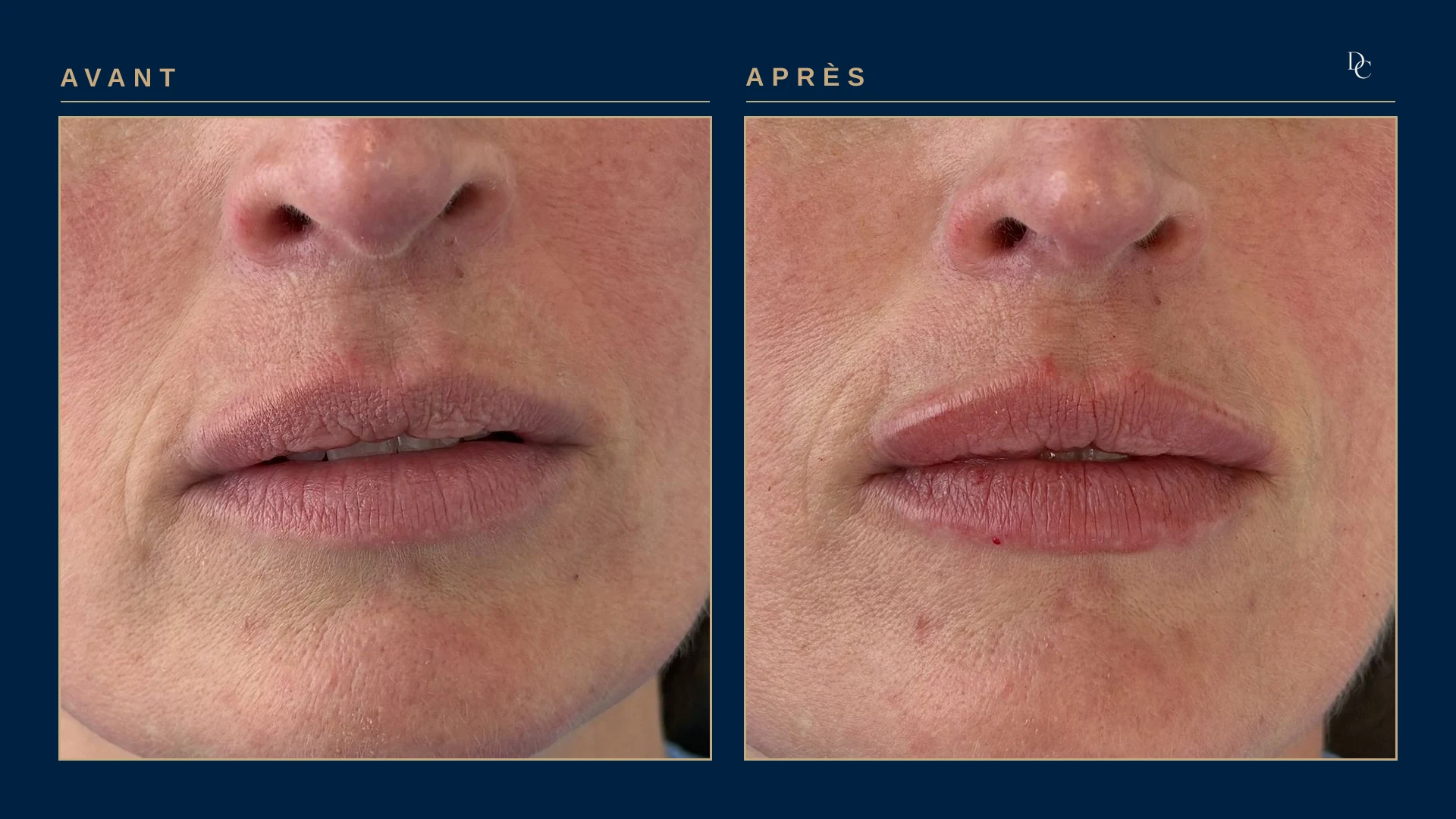 Gros plan sur les lèvres, avant et après 0,5 ml aux lèvres, de face, sur une femme dans la quarantaine : les deux lèvres ont plus de volume et leur contour est plus net.