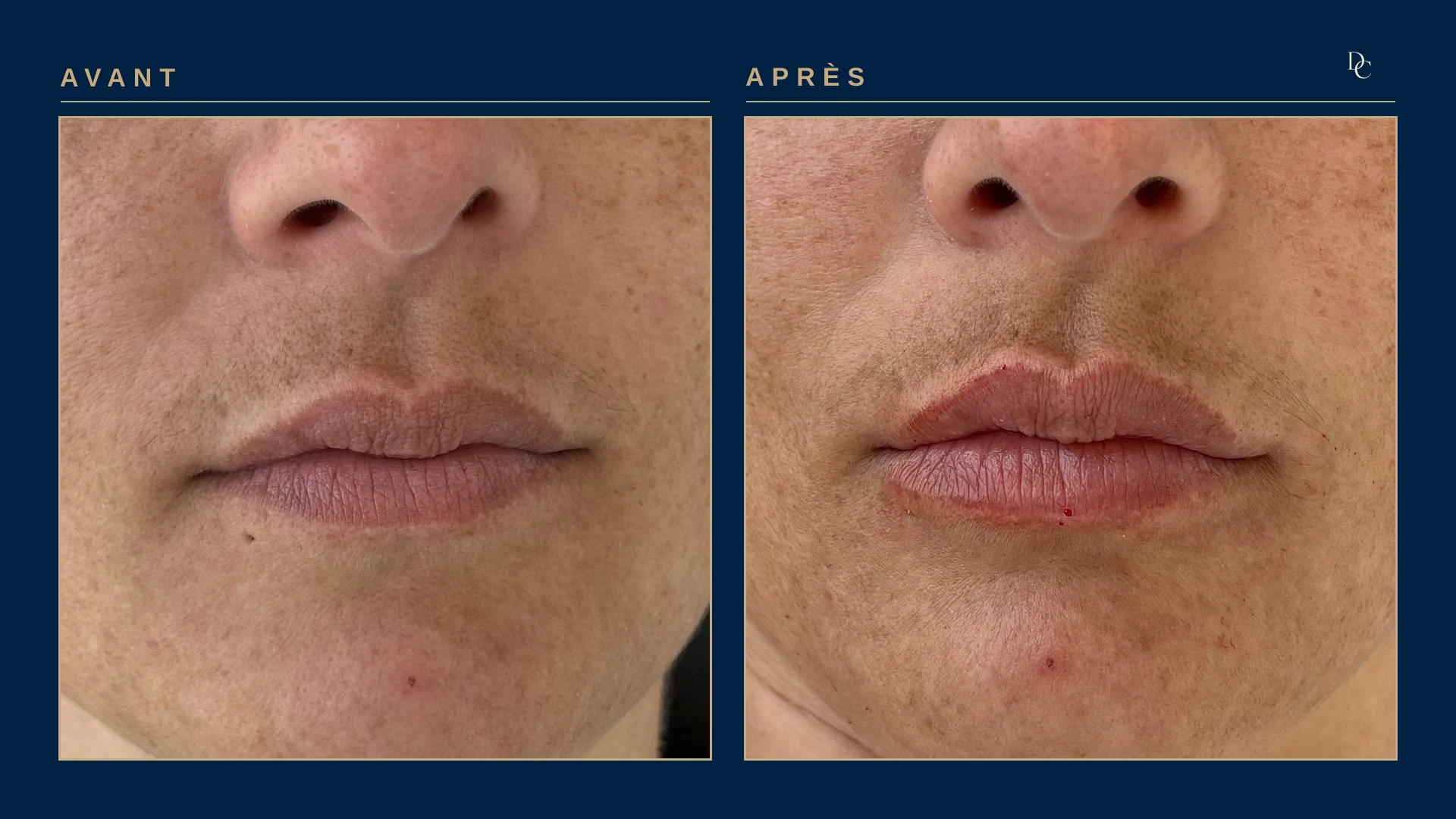 Gros plan sur les lèvres, avant et après 0,5 ml aux lèvres, allongée, sur une femme dans la trentaine : les lèvres, fines au départ, sont nettement plus pleines ; la tête est plus tournée sur la photo après.
