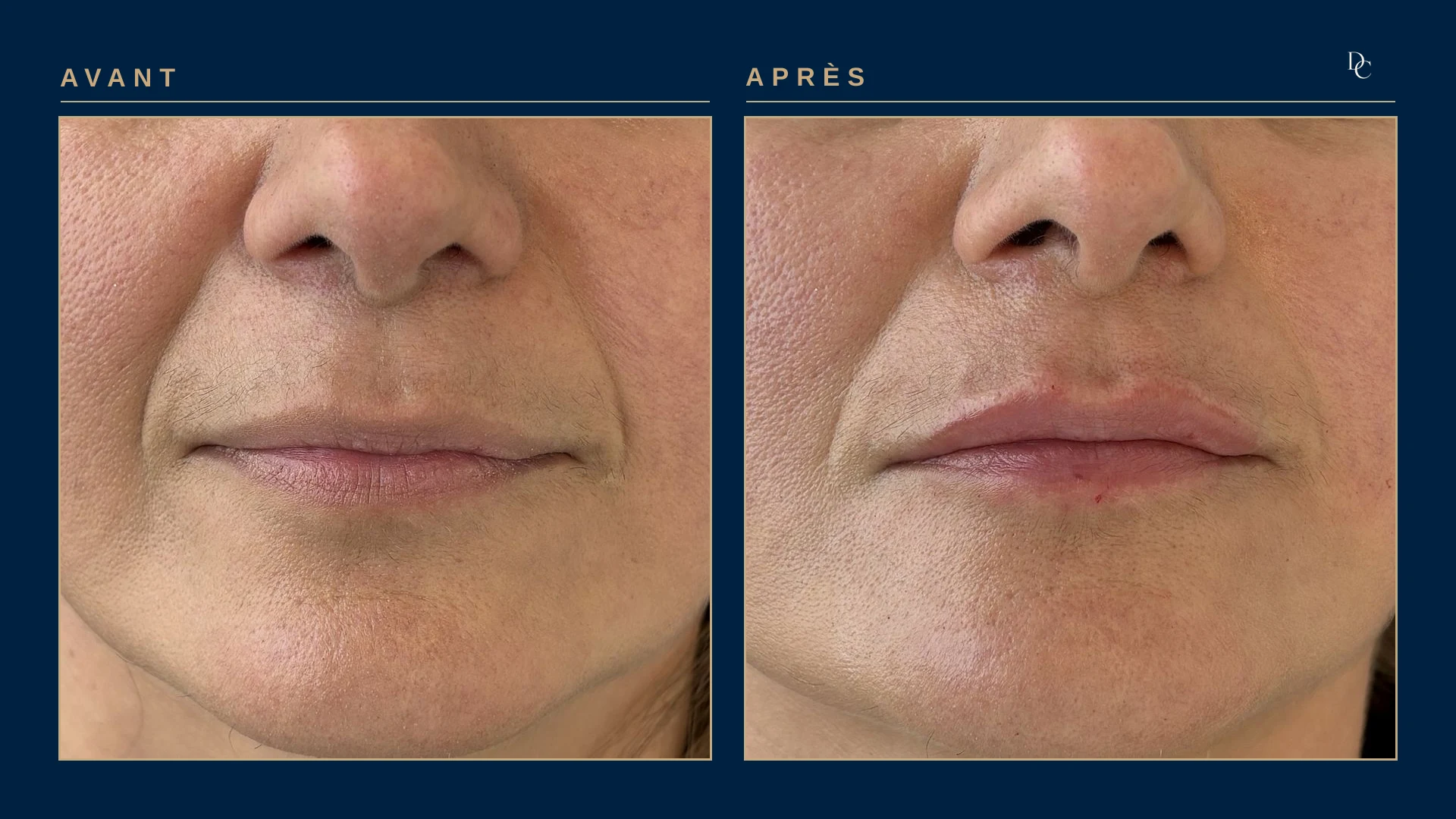 Gros plan sur les lèvres, avant et après 0,5 ml aux lèvres, de trois quarts, sur une femme dans la quarantaine : la lèvre supérieure se voit davantage et la bouche est mieux dessinée.
