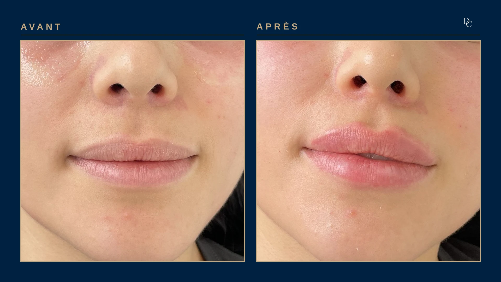 Gros plan sur les lèvres, avant et après 0,5 ml aux lèvres, de face, sur une jeune femme dans la vingtaine : les lèvres sont plus pleines et le contour reste naturel.