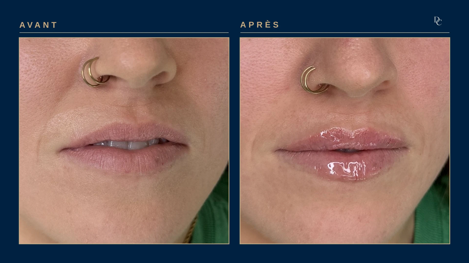 Gros plan sur les lèvres, avant et après, de trois quarts, allongée, sur une femme dans la trentaine : les deux lèvres ont plus de volume, la lèvre supérieure surtout.
