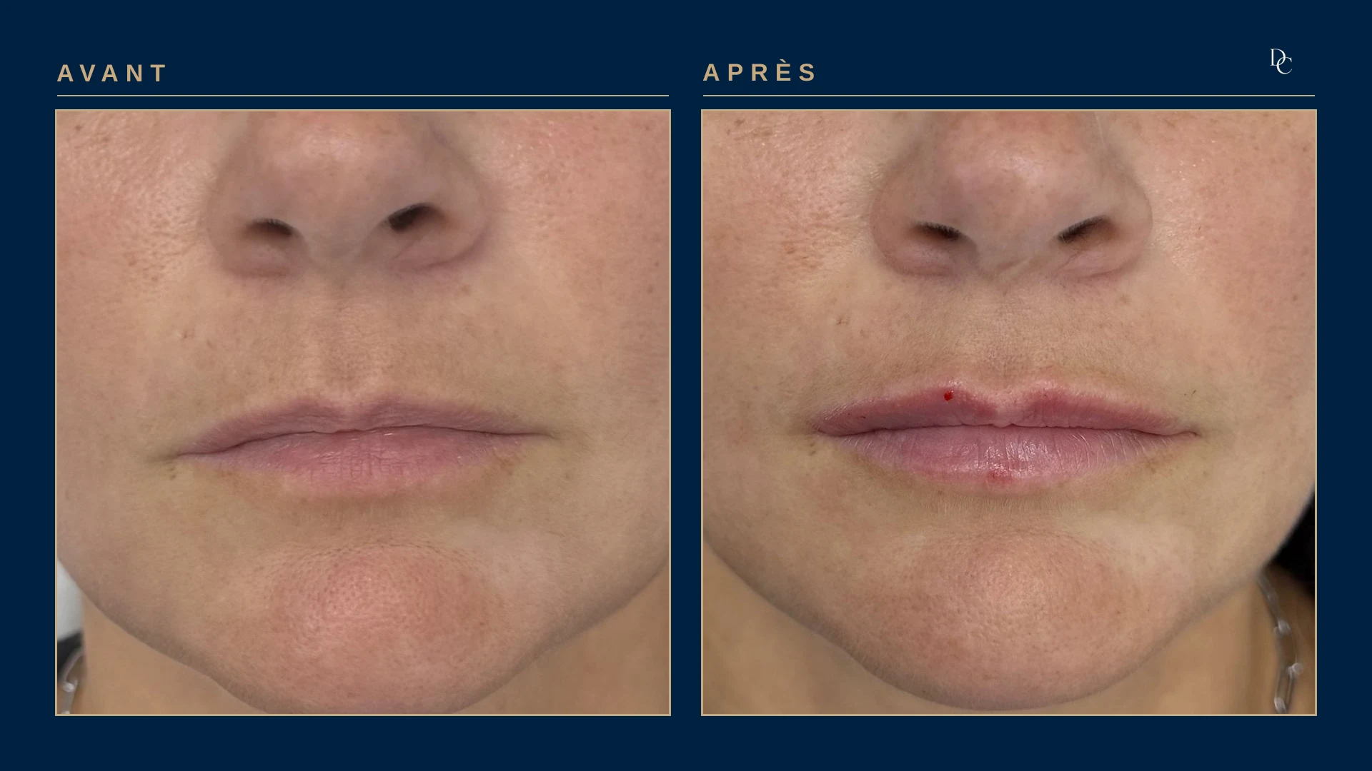 Gros plan sur les lèvres, avant et après, de trois quarts, allongée, sur une femme dans la quarantaine : la lèvre supérieure est un peu plus pleine, le changement reste discret.