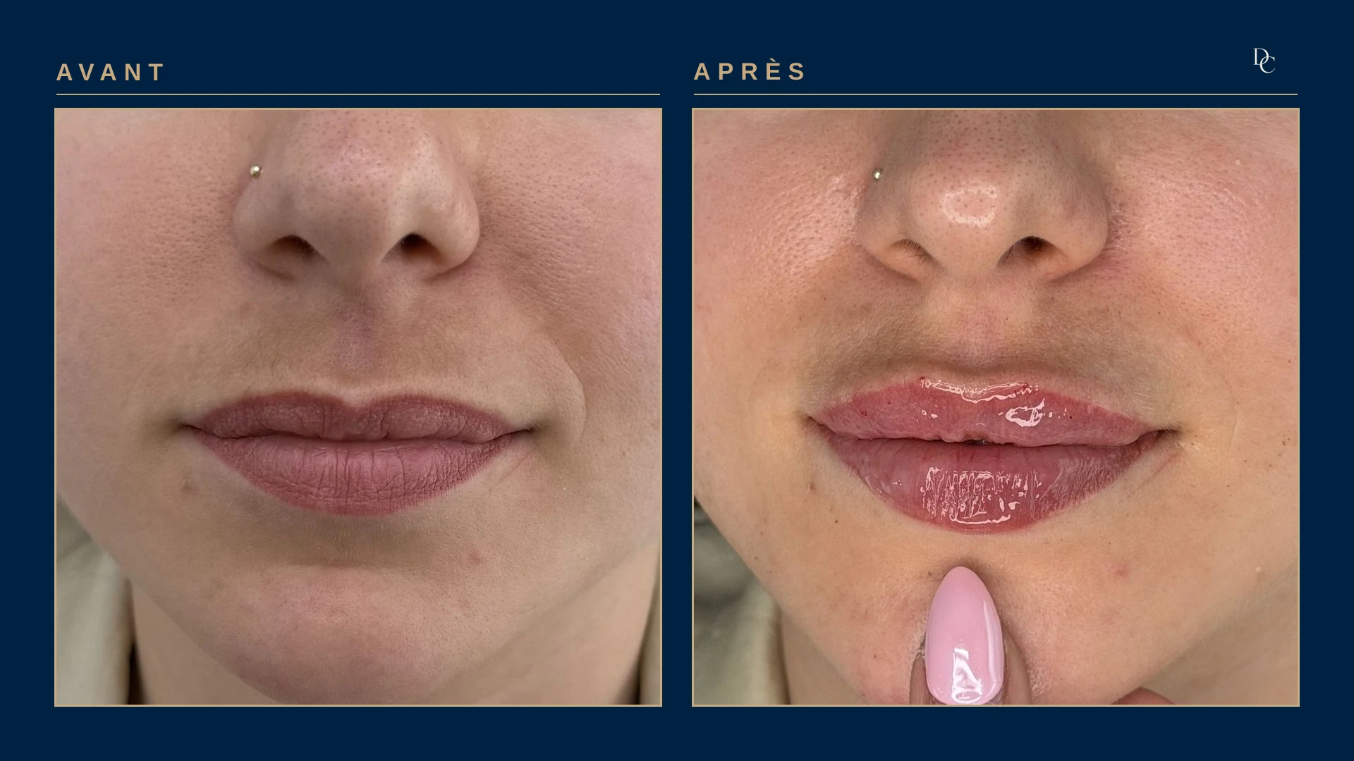 Gros plan sur les lèvres, avant et après, sur une jeune femme dans la vingtaine : les lèvres ont plus de volume et le contour de la lèvre supérieure est plus marqué.