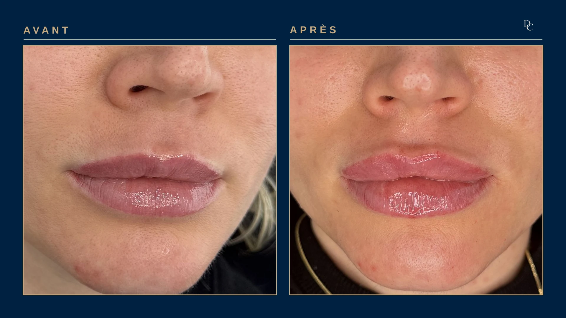 Gros plan sur les lèvres, avant et après une demi-seringue aux lèvres, allongée, sur une femme dans la trentaine : les lèvres sont plus pleines, surtout la lèvre inférieure.