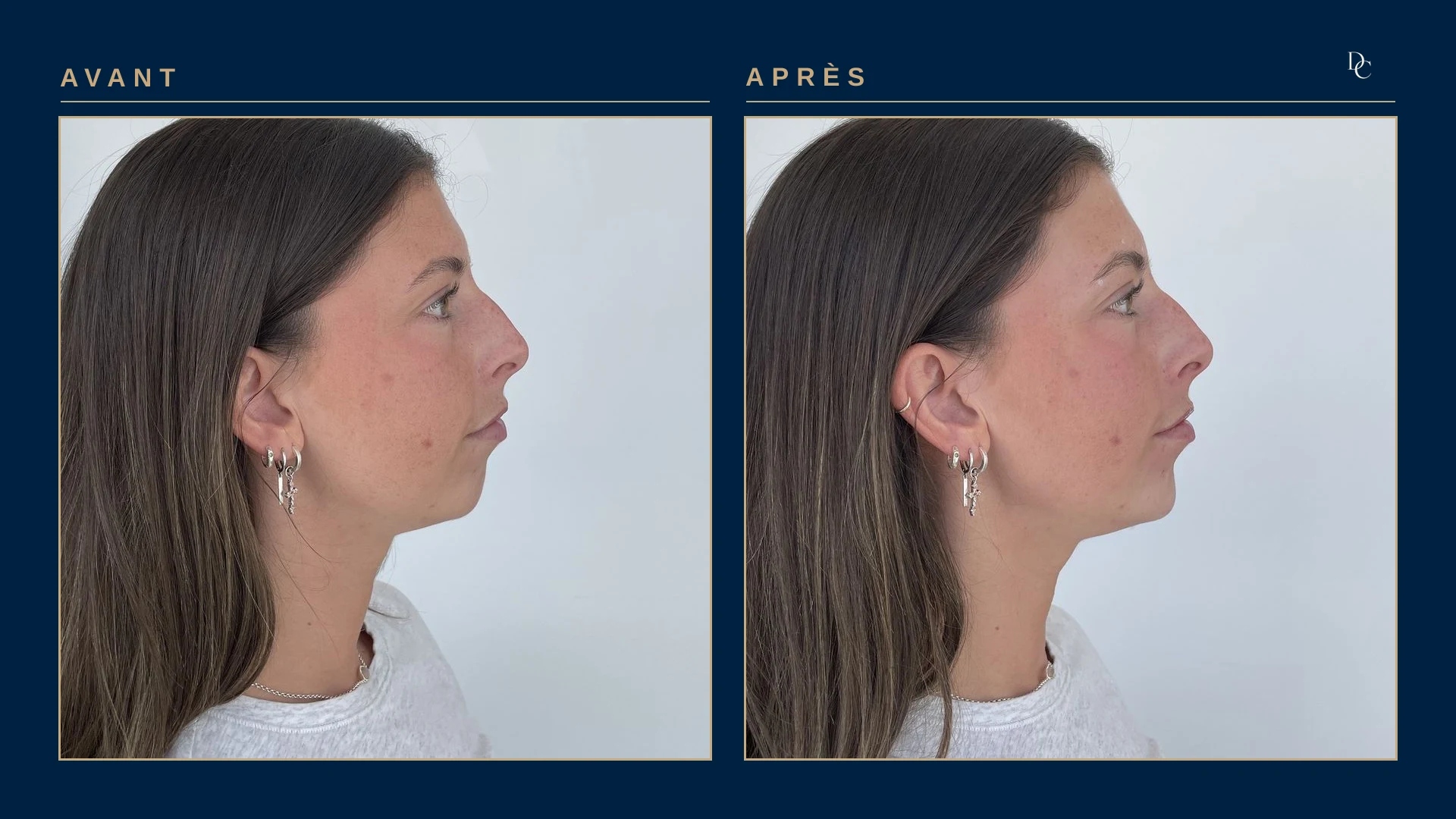 Avant et après 1 ml au menton, de profil, sur une jeune femme dans la vingtaine : le menton avance et le profil entre le nez, la bouche et le menton est plus équilibré.