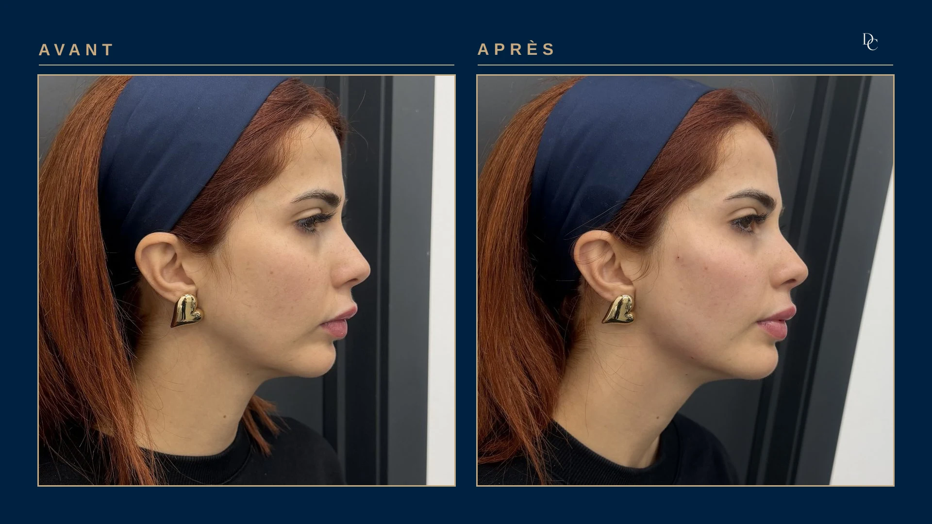 Avant et après, de profil, sur une femme dans la trentaine : le menton est plus projeté et l’angle sous le menton plus net.