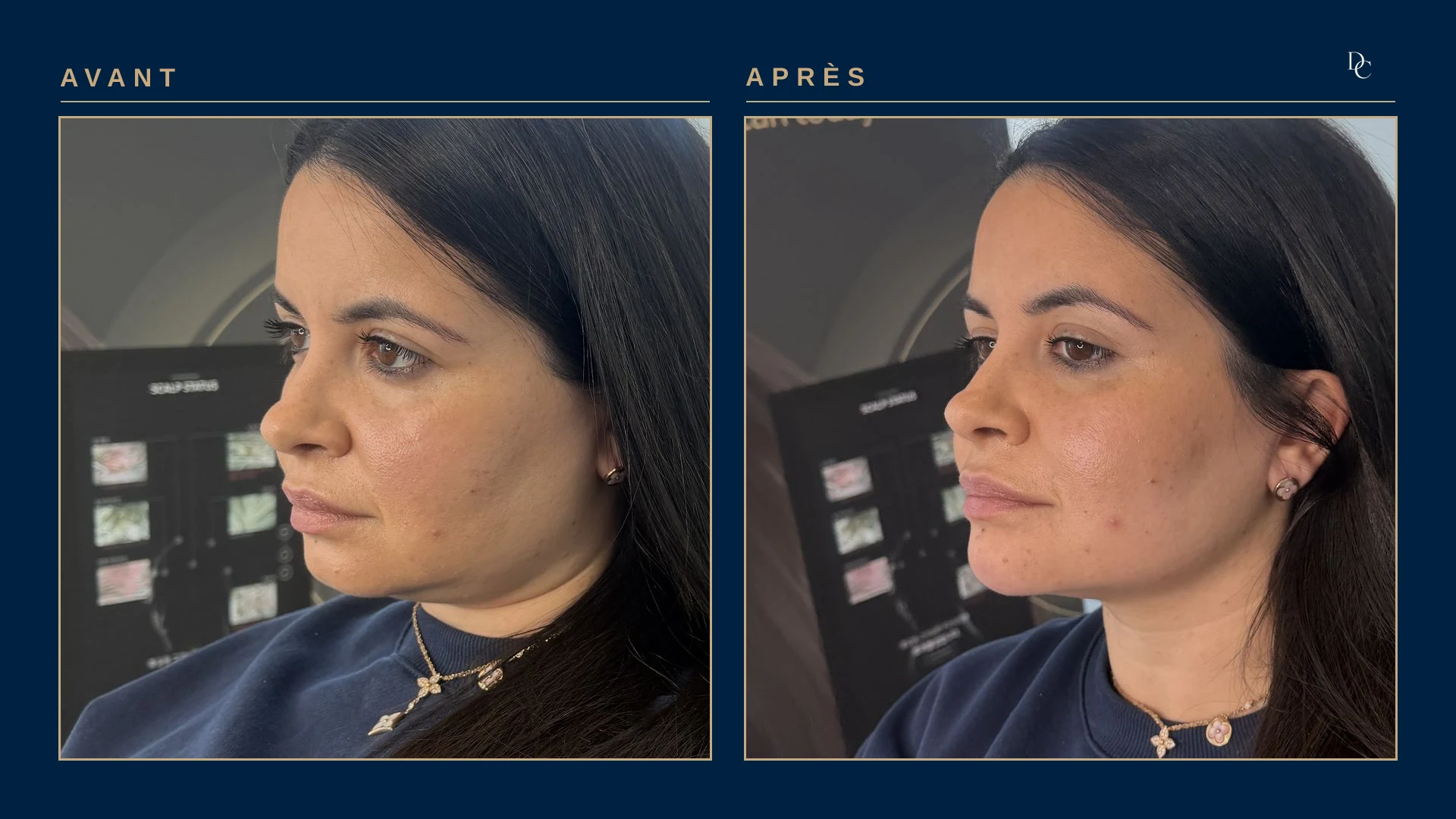 Avant et après, de trois quarts, sur une femme dans la trentaine : le menton est plus projeté et le bas du visage plus équilibré.