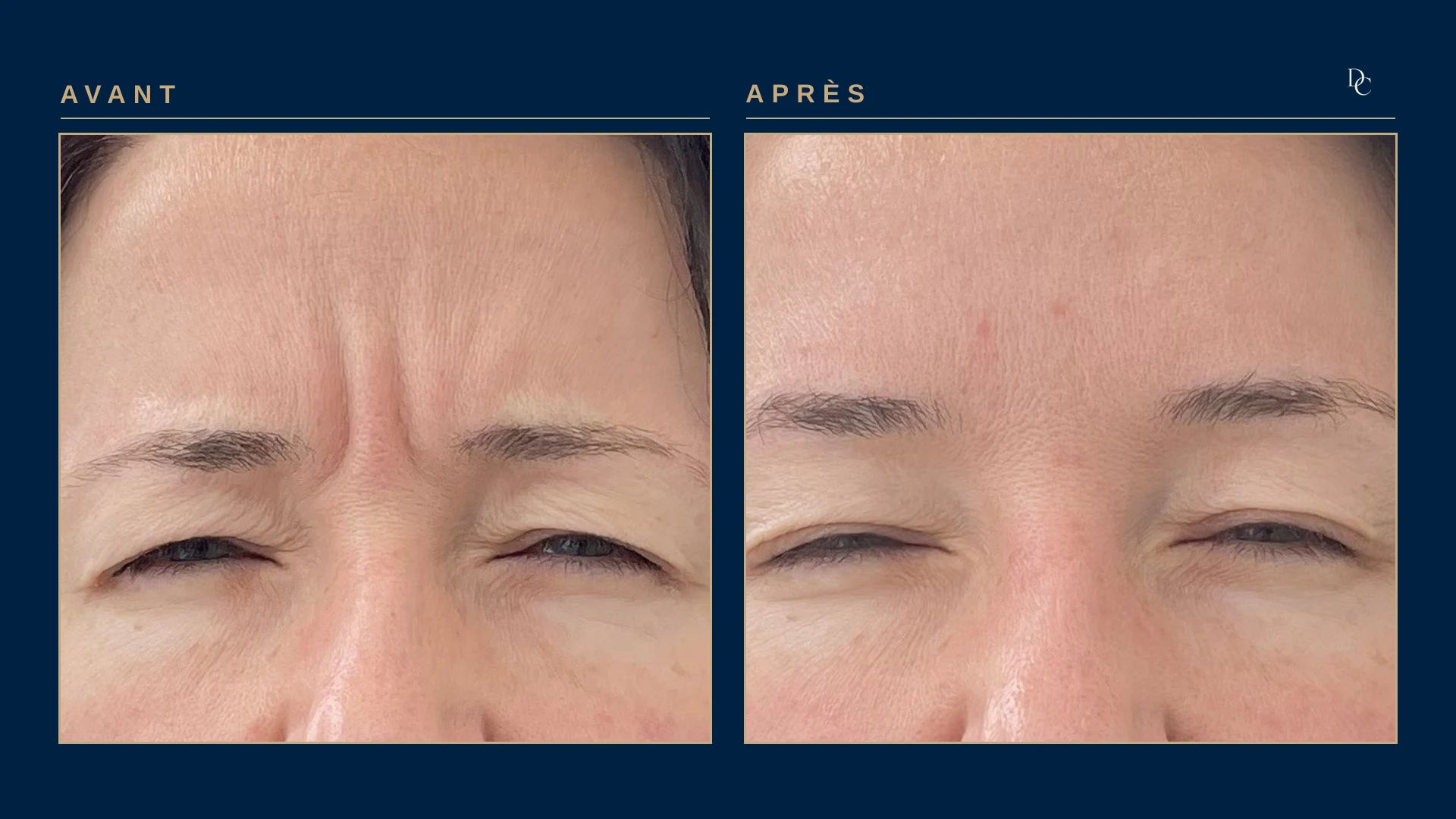 Woman in her forties, front view, frowning with squinted eyes: before, deep vertical folds between the eyebrows; after, the area between the eyebrows stays almost smooth.