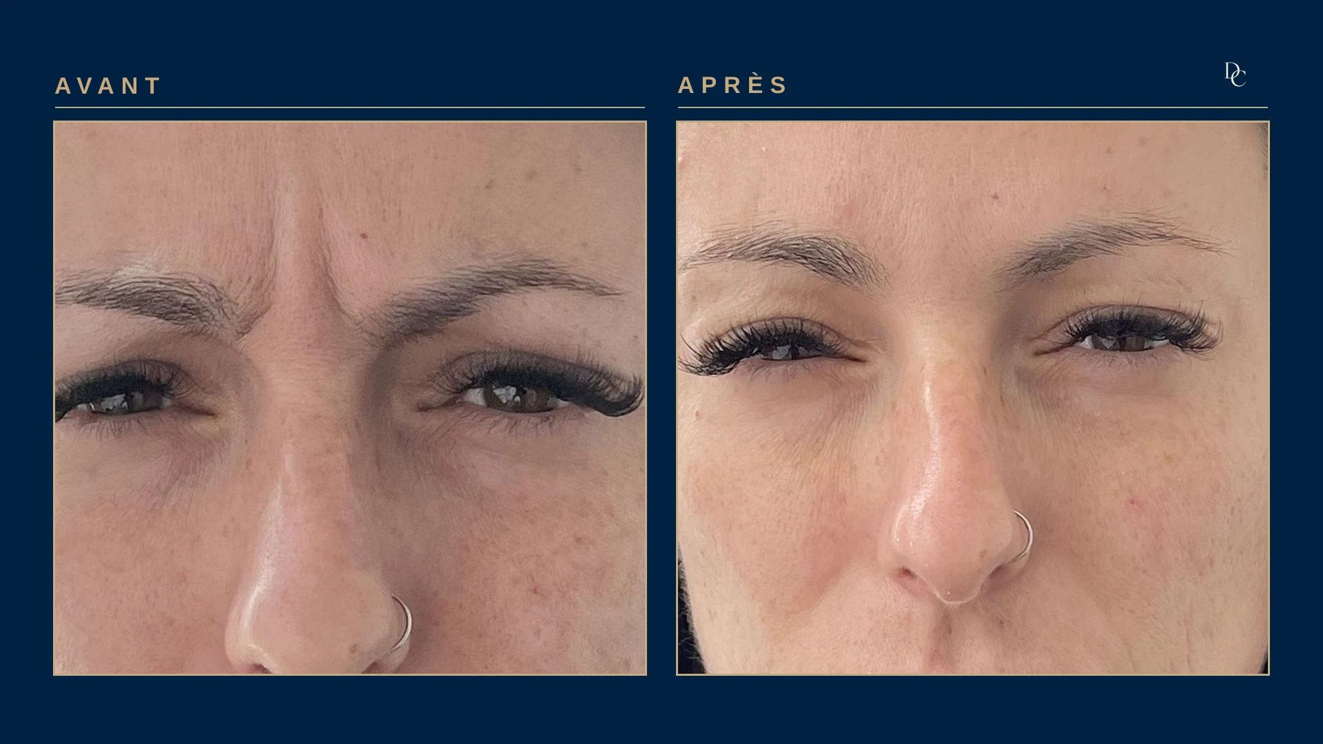 Woman in her thirties, front view, frowning: before, two deep vertical folds between the eyebrows; after, the same frown no longer creases them.