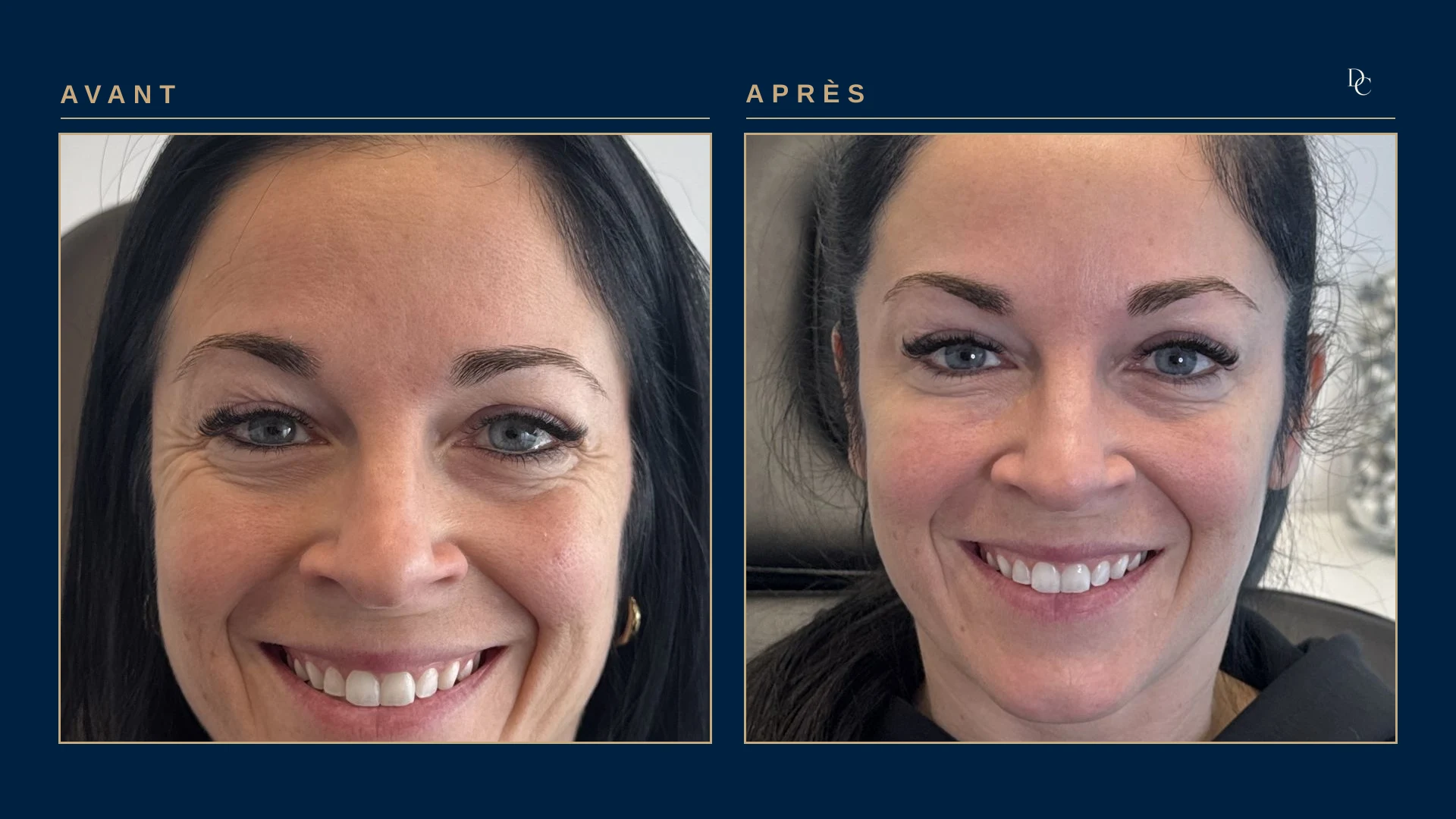 Woman in her forties, front view, broad smile: before, marked crow’s feet at the corners of the eyes; after, the same smile leaves the corners of the eyes almost smooth.