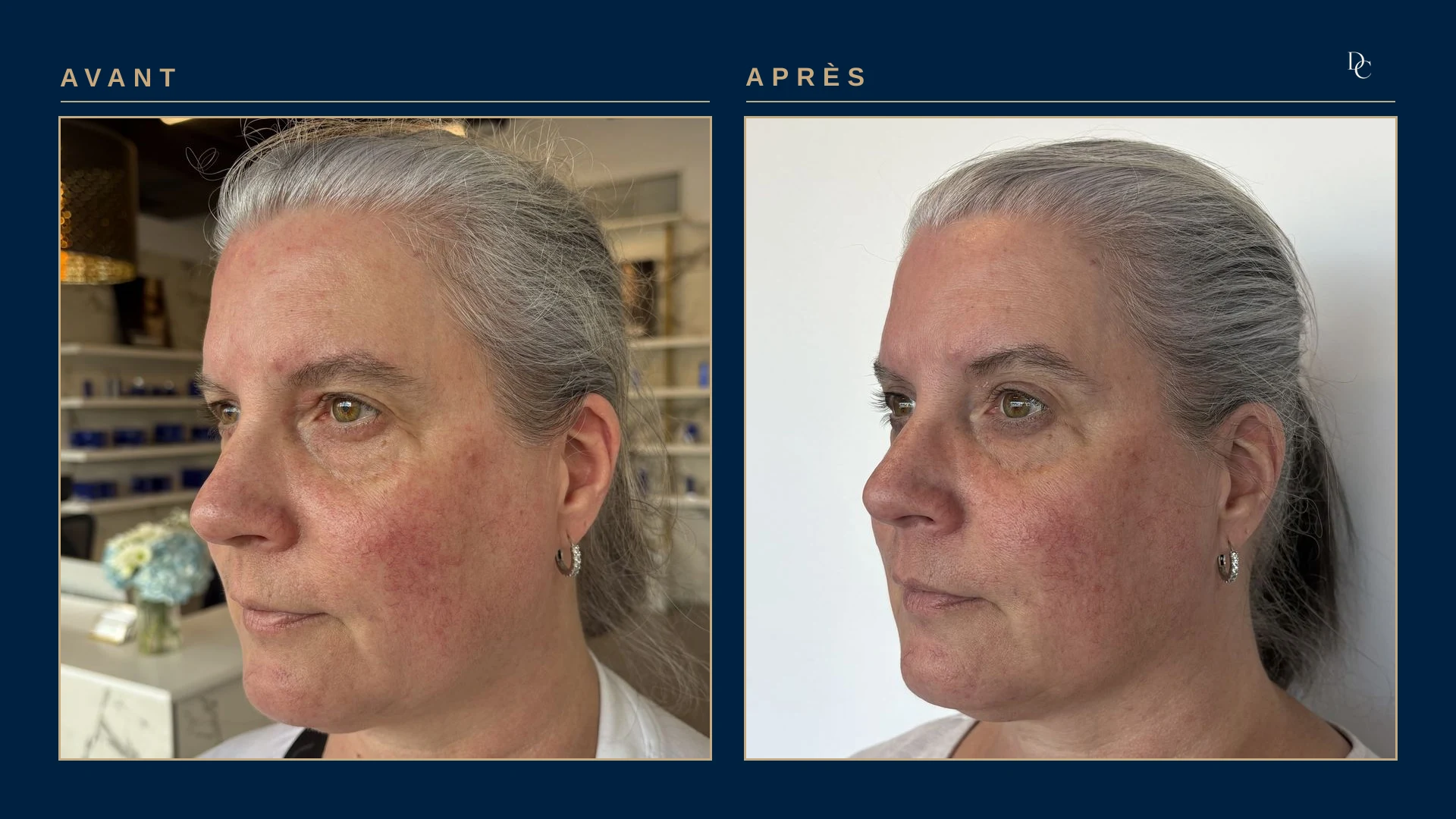 Même patiente de trois quarts, côté droit du visage, avant et après : la rougeur de la pommette est plus pâle après.