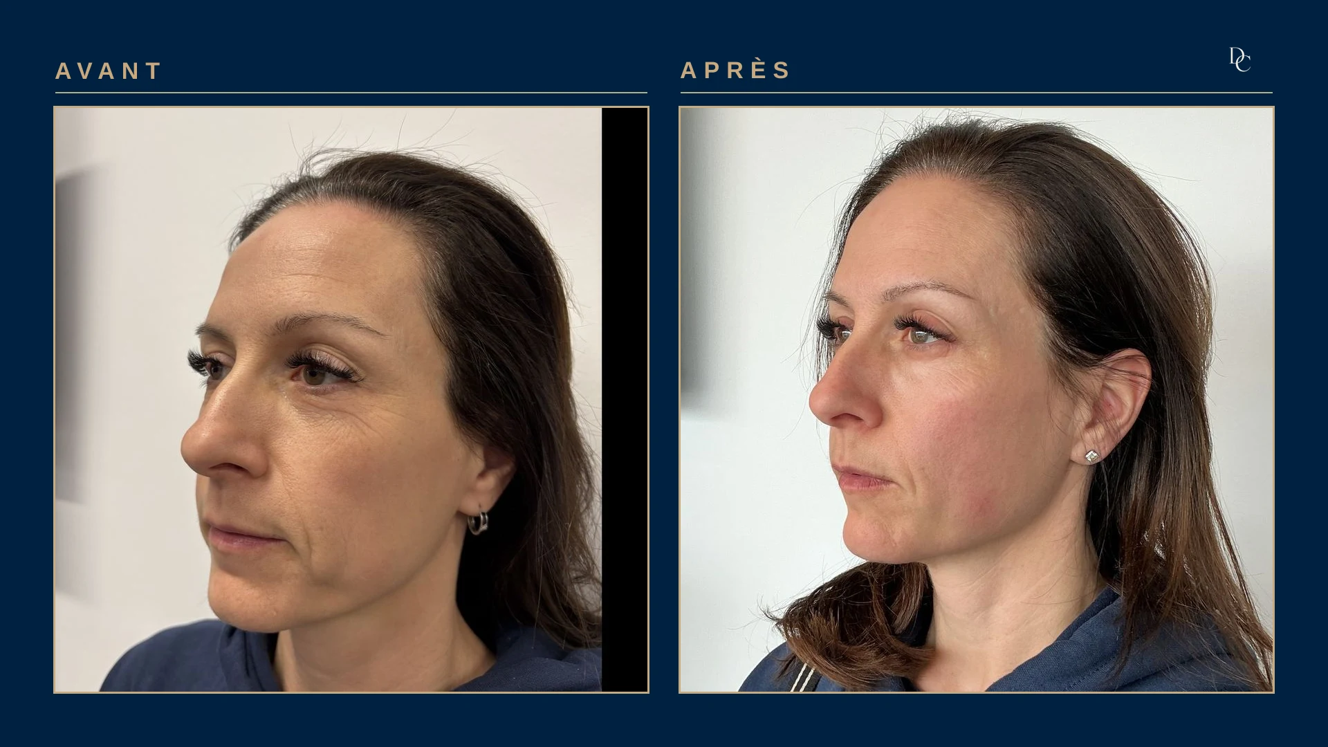 Même patiente, de trois quarts, côté droit du visage, avant et après trois séances : les ridules du coin de l’œil et le pli près de la bouche sont moins marqués ; l’après est pris un peu plus de profil.