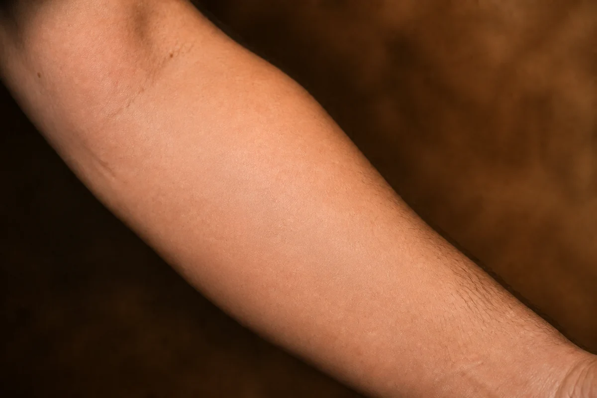 Forearm with clear skin, no trace of the removed tattoo
