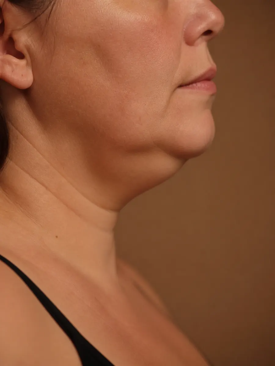 Fat under the chin blurring the line between chin and neck